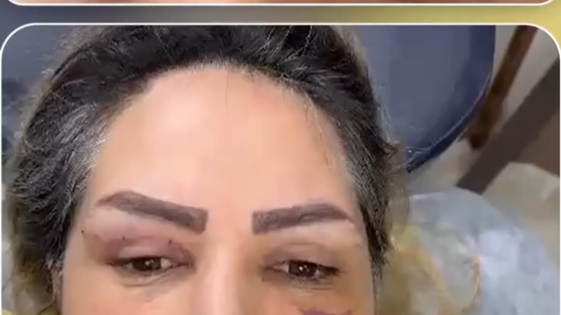 فیلم بلافاصله بعد از جراحی بلفاروپلاستی | دکتر سنجری دکتر خشایار سنجری متخصص جراحی جنرال و زیبایی