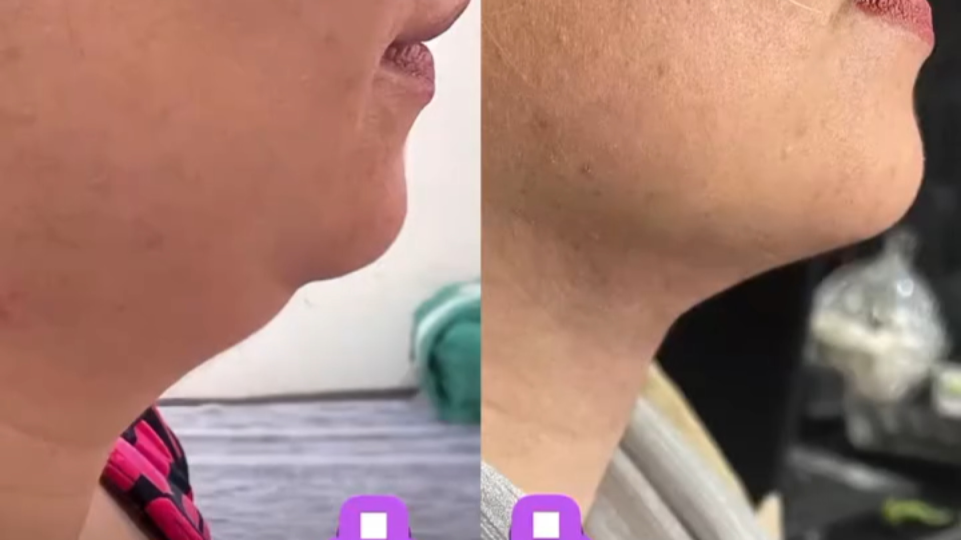 لیپو غبغب| دکتر خشایار سنجری دکتر خشایار سنجری متخصص جراحی جنرال و زیبایی