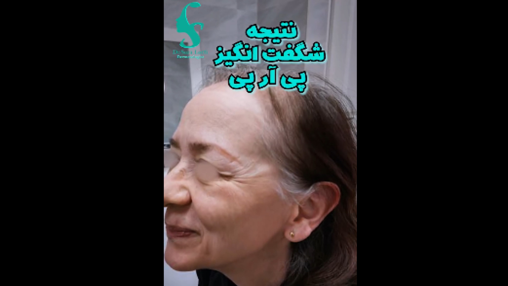 تاثیر پی ار پی بر رویش مو دکتر سار ا لطفی