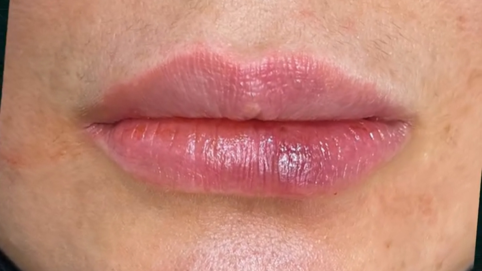 نمونه کار فیلر لب دکتر سار ا لطفی