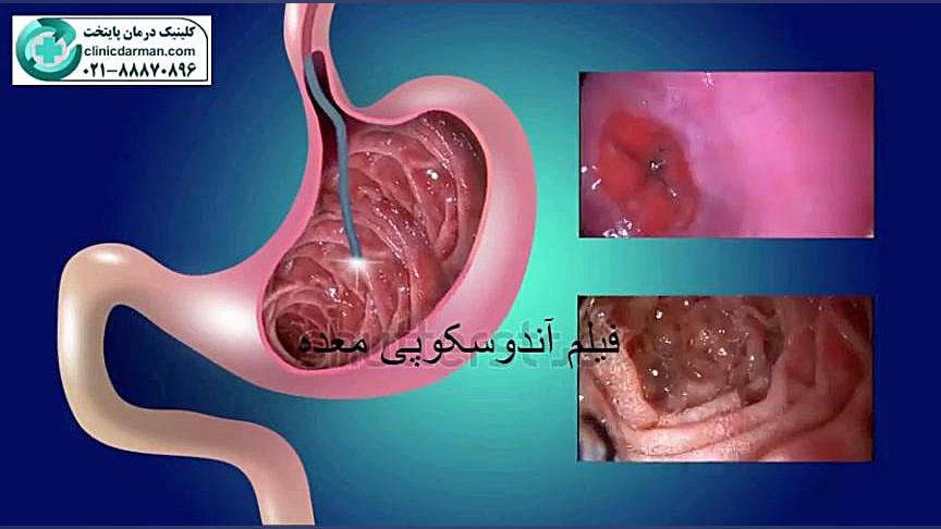 آندوسکوپی چیست؟clinicdarman.com هایفوتراپی