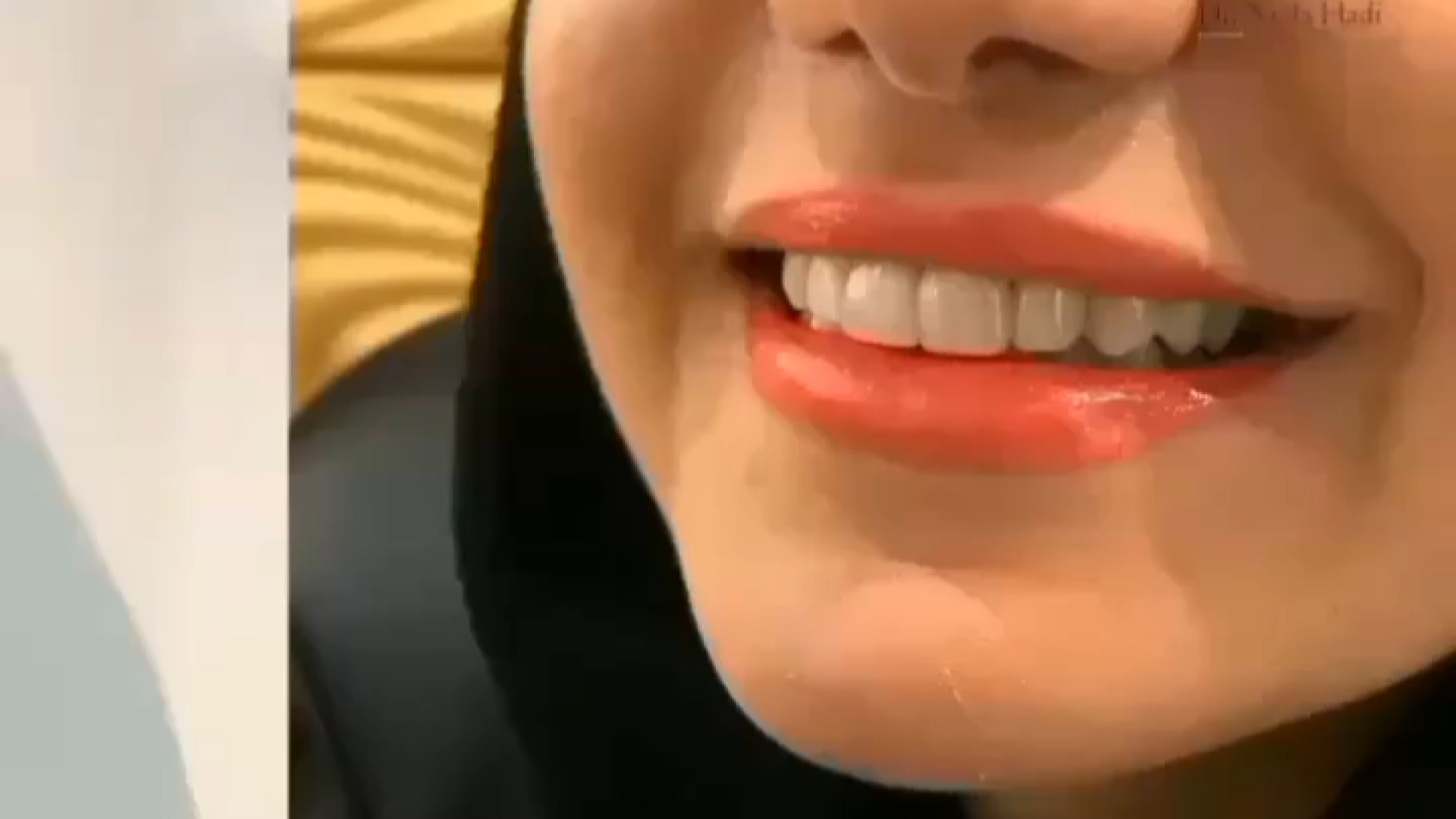 نمونه کار کامپوزیت ونیر دکتر ندا هادی-دندانپزشک زیبایی