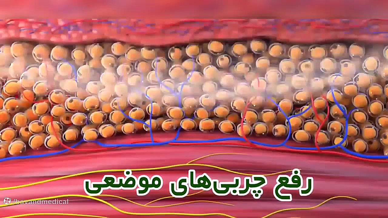 ویوکر، دستگاه تخصصی تناسب اندام و جوانسازی عصب‌کشی