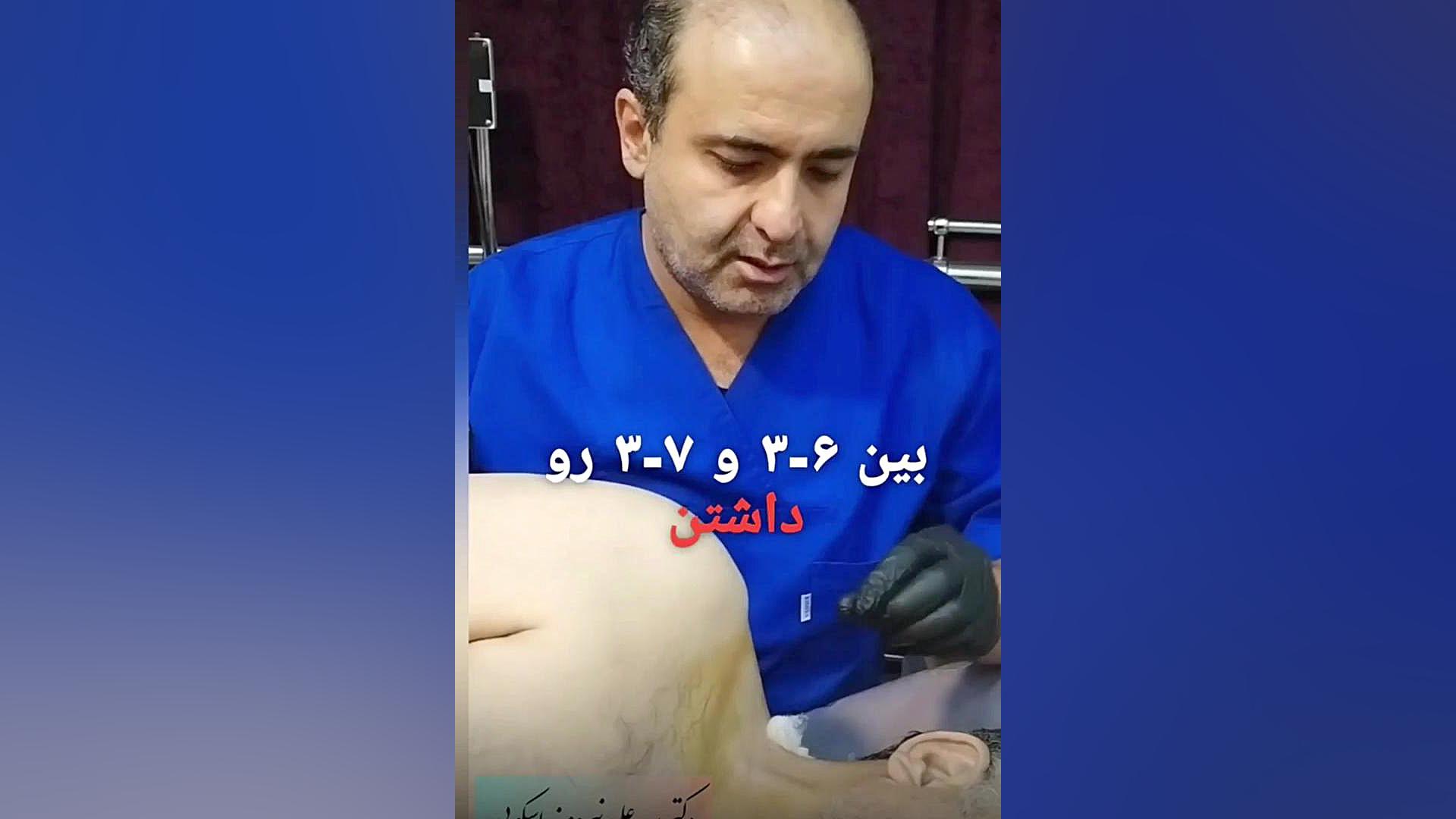 تزریق اپیدورال تحت گاید سونوگرافی هایفوتراپی