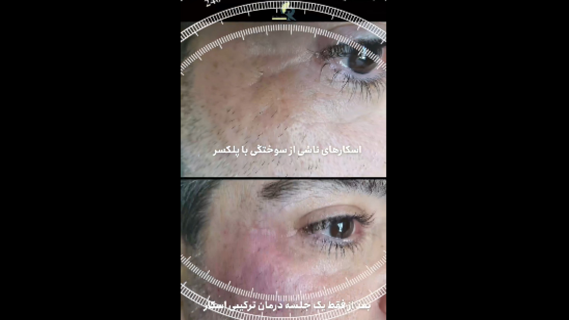 درمان ترکیبی اسکار دکتر ایمان روغنی جراح و متخصص پوست و مو