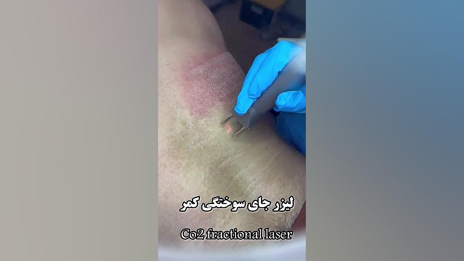 لیزر جای سوختگی پروتز سینه
