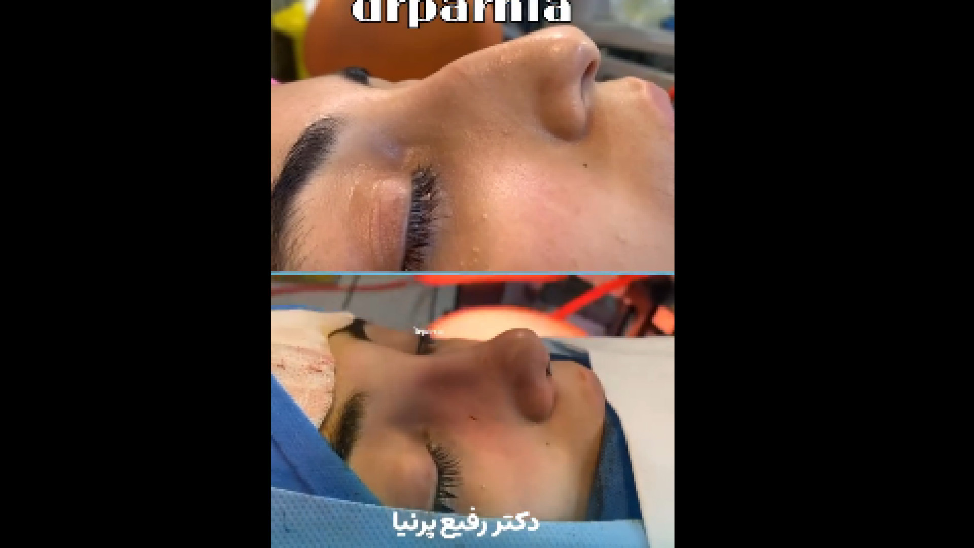 قبل و بعد عمل بینی دکتر رفیع پرنیا فوق تخصص پلاستیک