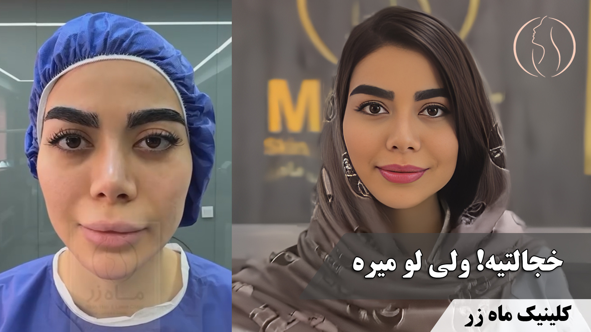 خجالتی اومد، پررو رفت! ️ ( کلینیک زیبایی ماه زر ) pCO2