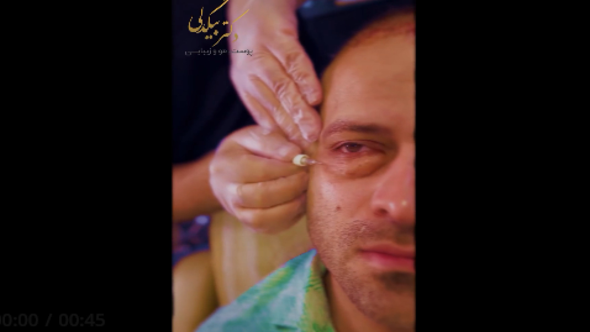 درمان تیرگی زیر چشم با کربوکسی تراپی نوروجراحی فانکشنال