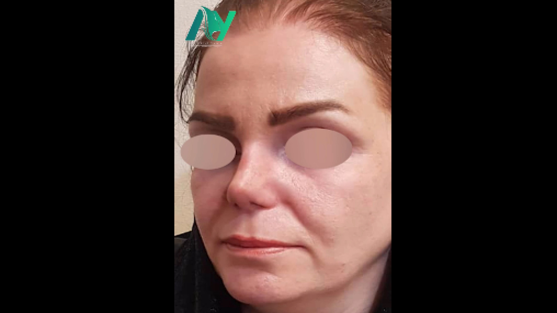 نتیجه رینوپلاستی دکتر محمودرضا اصحاب یمین - فوق تخصص پلاستیک