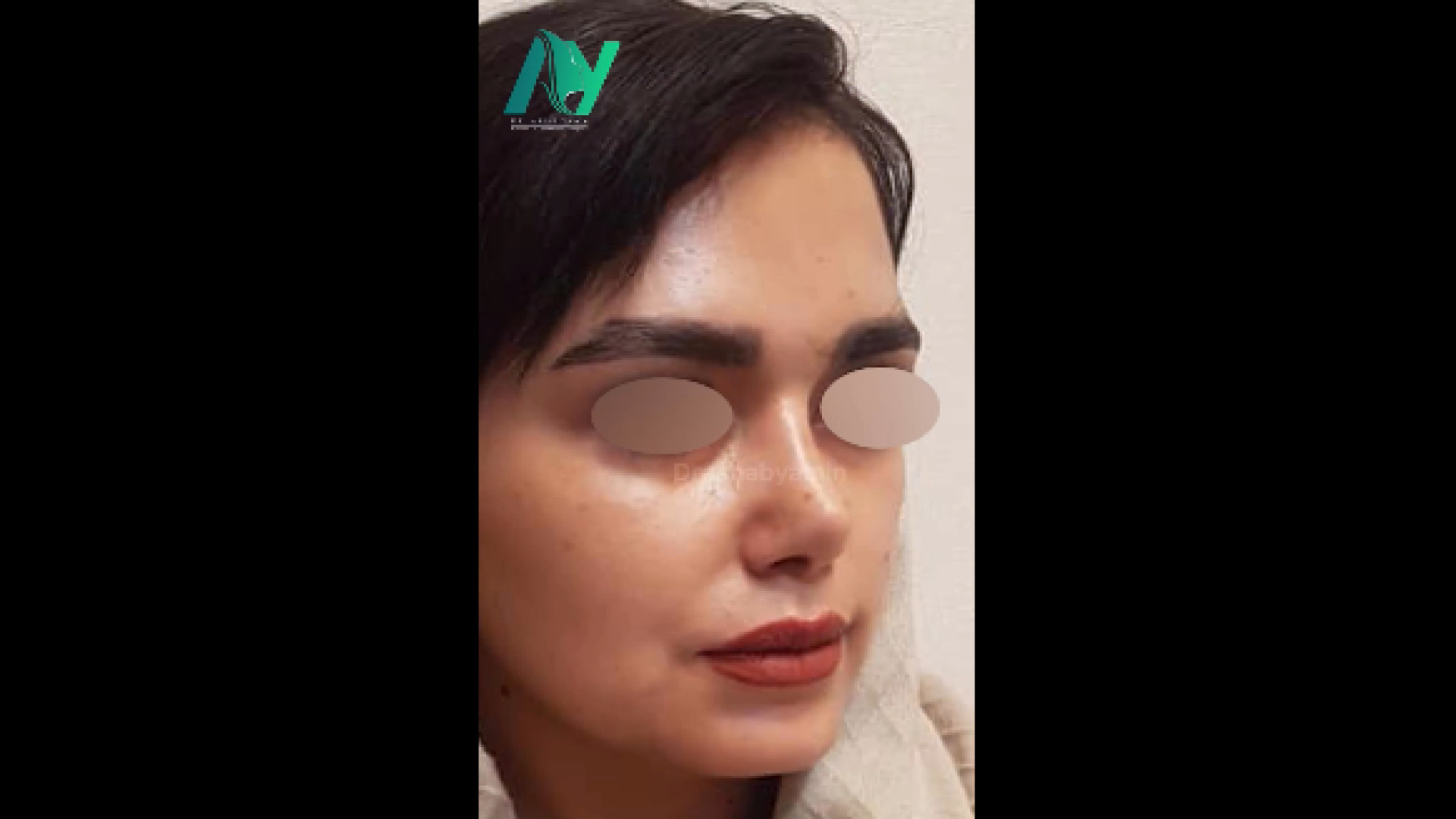نتیجه جراحی زیبایی بینی دکتر محمودرضا اصحاب یمین - فوق تخصص پلاستیک