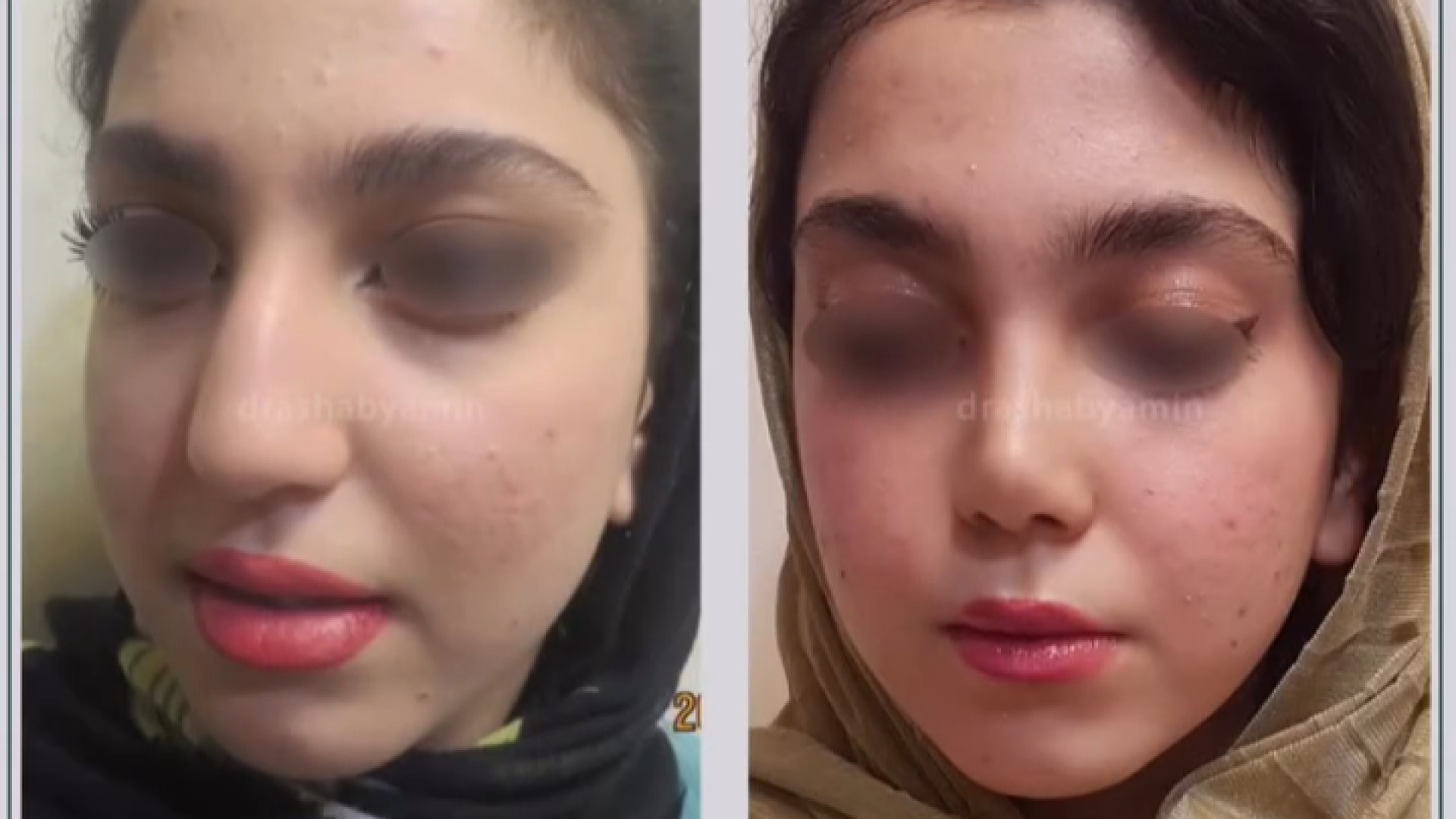 نتیجه جراحی بینی دکتر محمودرضا اصحاب یمین - فوق تخصص پلاستیک