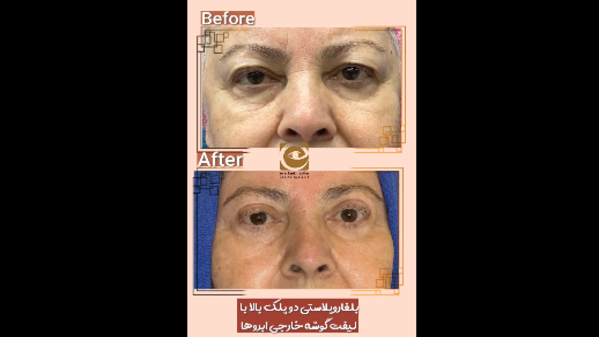 بلفاروپلاستی و لیفت گوشه خارجی ابروها دندانپزشک زیبایی