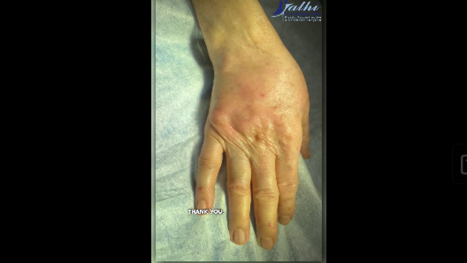 تزریق چربی به دست دکتر حمید رضا فتحی فوق تخصص جراحی پلاستیک