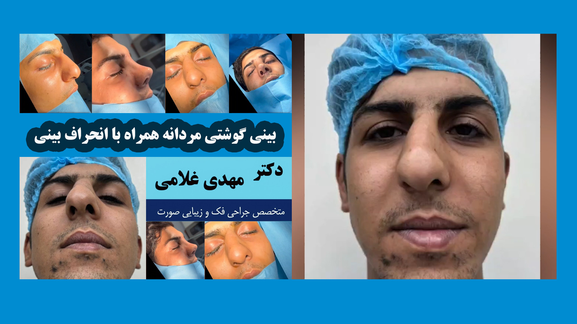 بینی گوشتی مردانه همراه با انحراف بینی دکتر مهدی غلامی