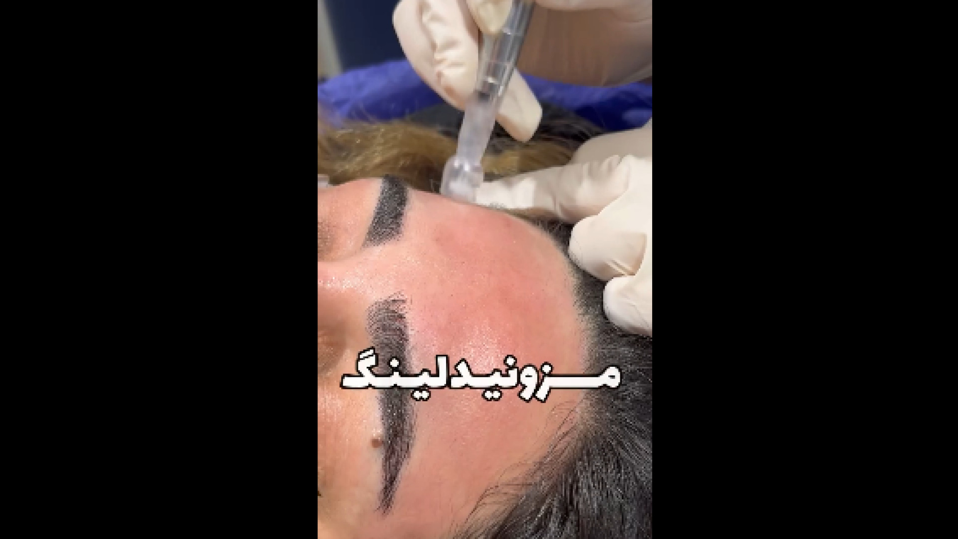 جوانسازی با مزونیدلینگ دکتر صدیقه نائیجی | متخصص پوست و مو در قم