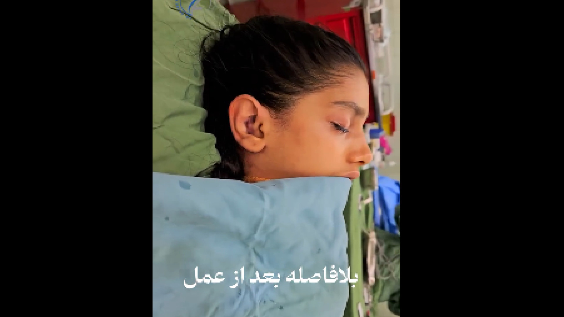 نمونه جراحی اتوپلاستی دکتر هاتف زیرک زاده - فوق تخصص جراحی پلاستیک