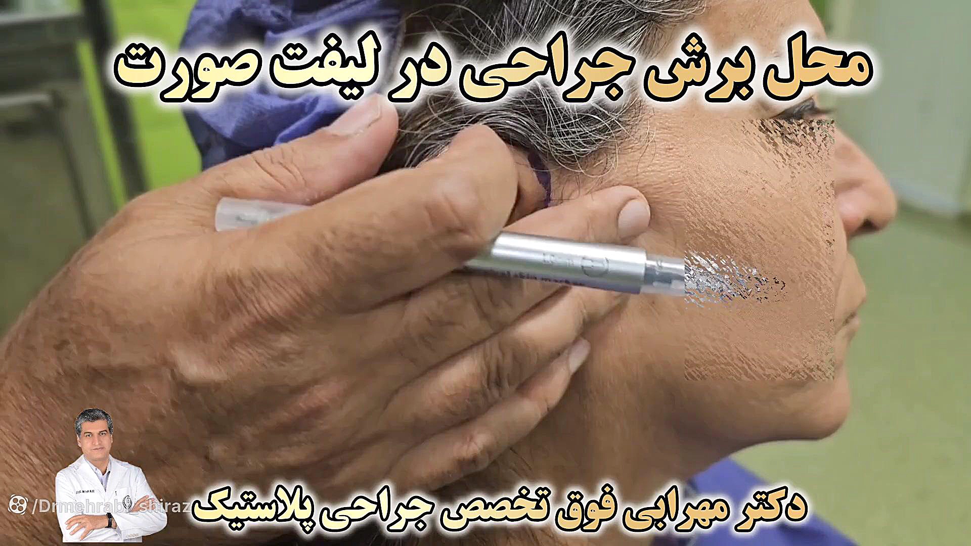 #لیفت_صورت #خط_بخیه در لیفت صورت #دکترمهرابی #شیراز GRO-Seq