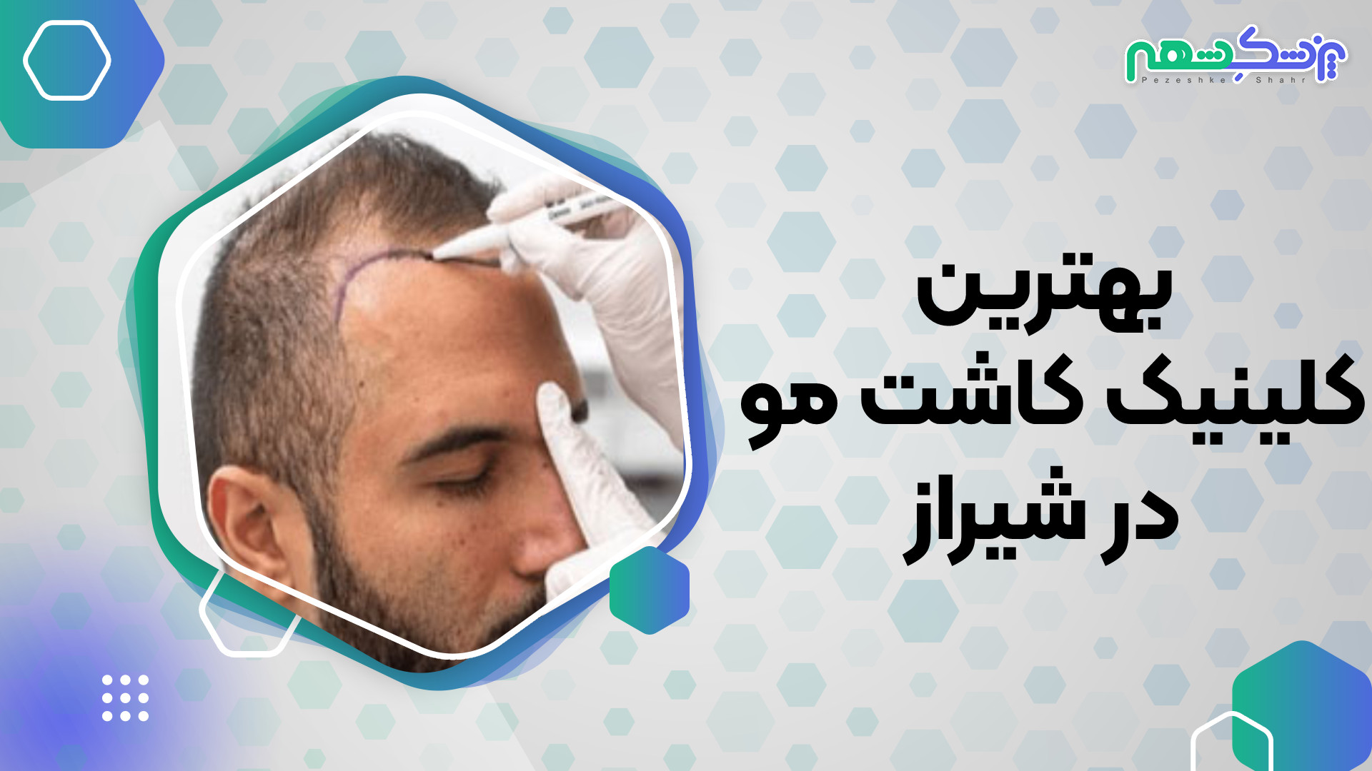 بهترین کلینیک کاشت مو در شیراز - پزشک شهر پلی‌مایالژیا روماتیکا