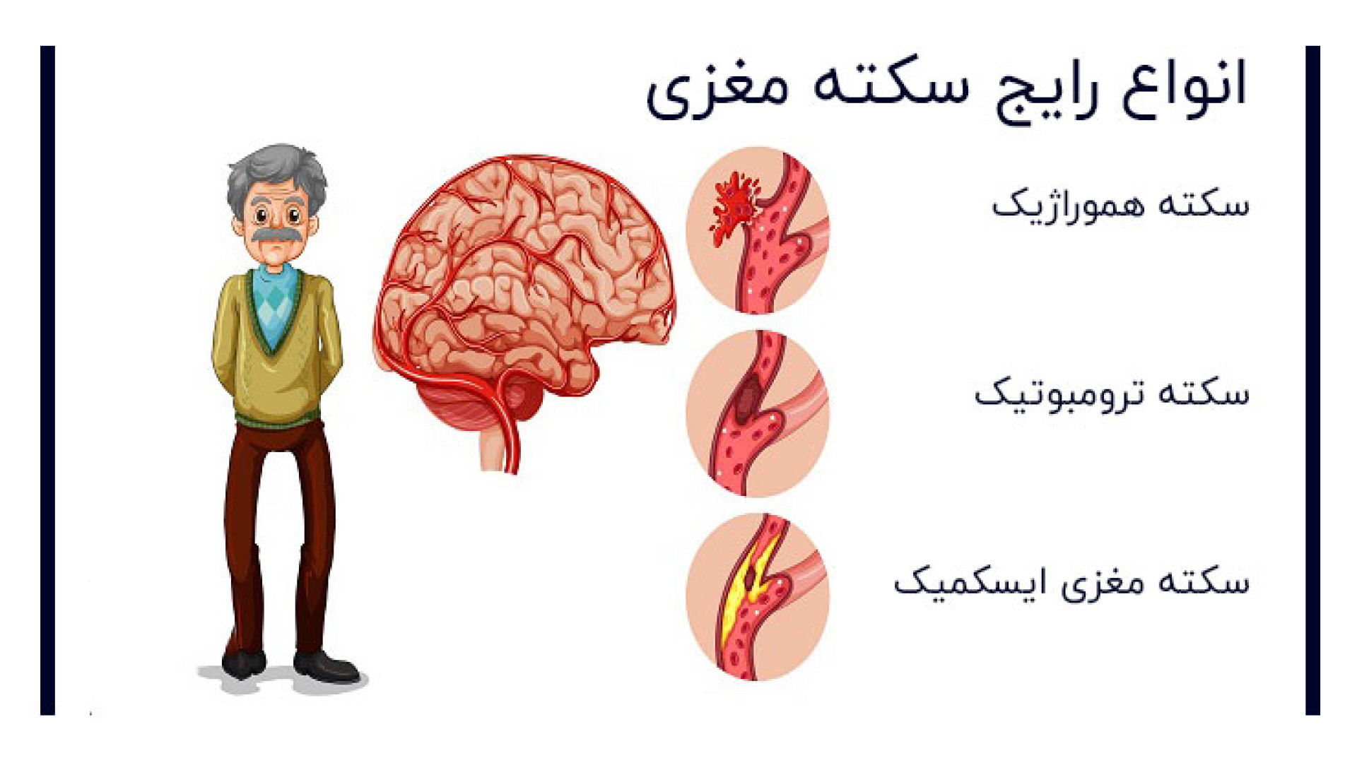 آشنایی با انواع سکته مغزی پریودنتیکس