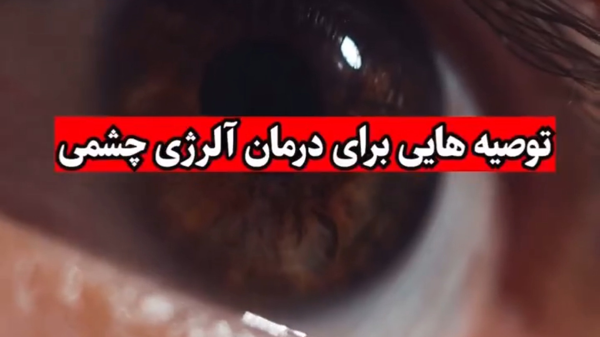 نکات درمان آلرژی چشمی دکتر نسرین مرتضوی فر