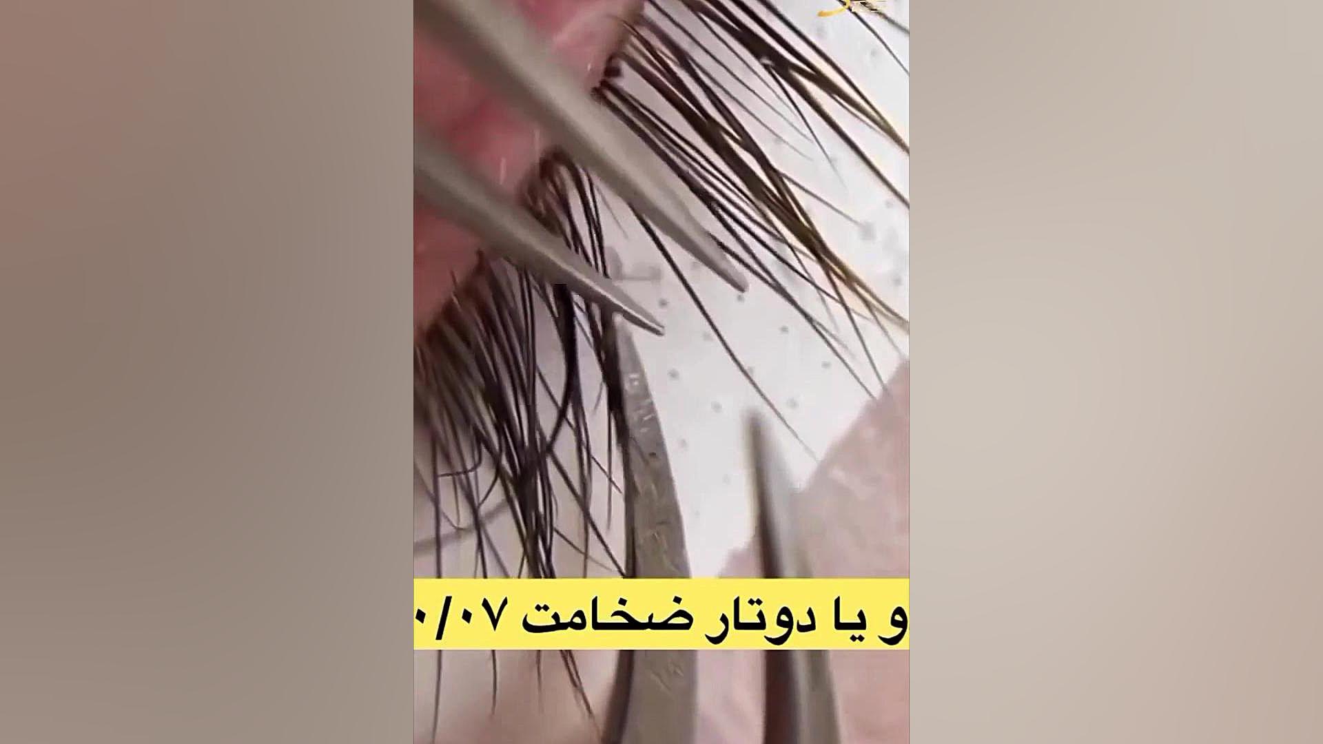 آموزش اکستنشن کلاسیک در 20 ثانیه آزمون NanoString