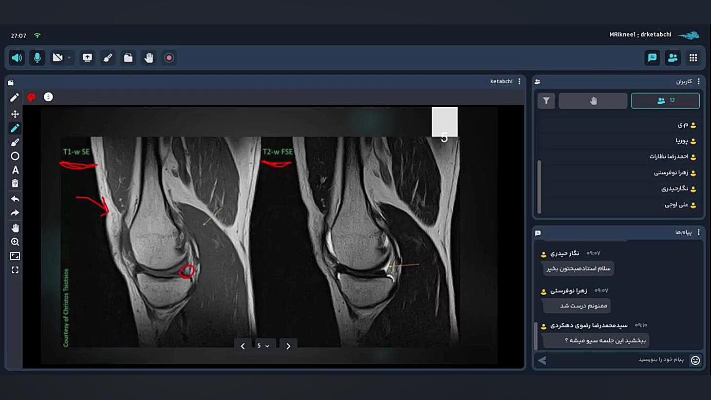 تفسیر تصاویر MRI زانو پوسیدگی دندان