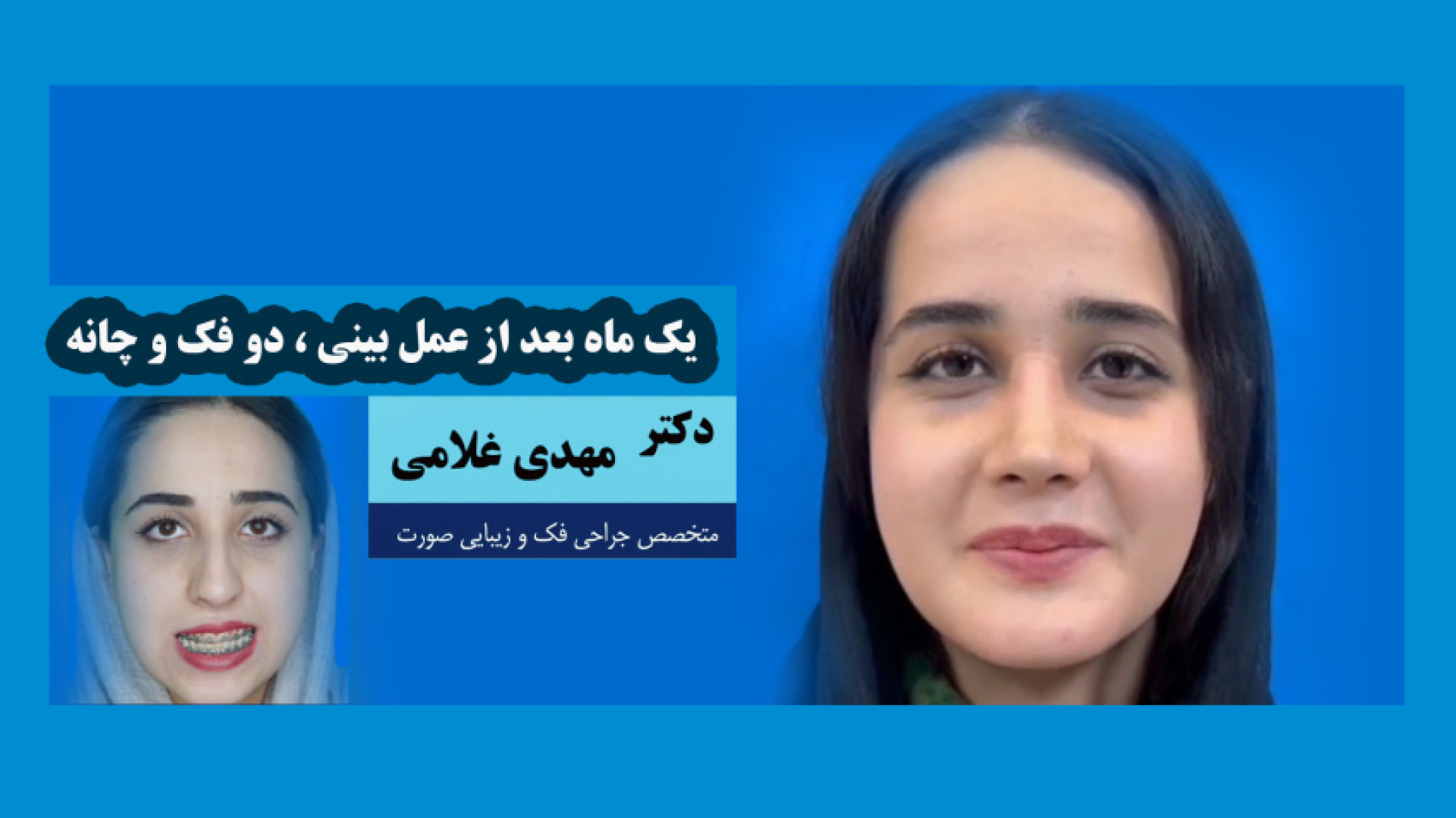 نتیجه جراحی بینی و فک و چانه بعد از یک ماه دکتر مهدی غلامی