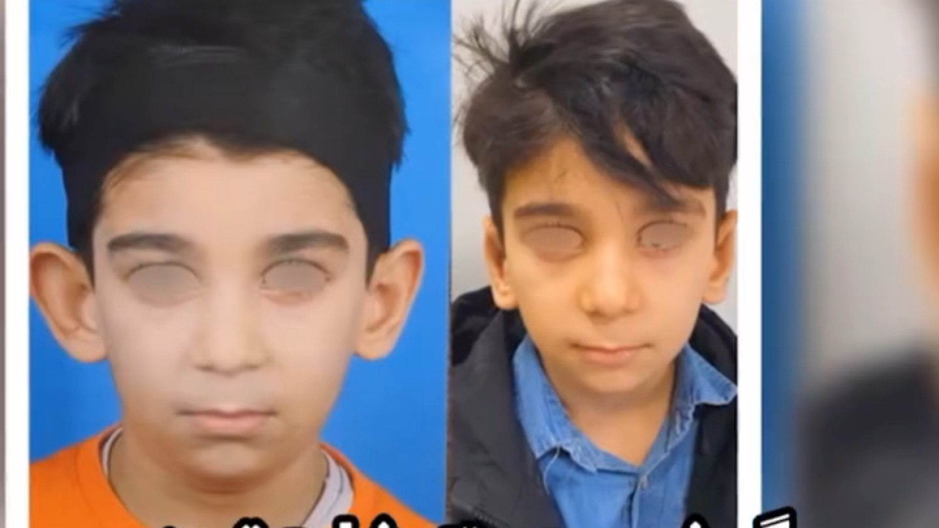 نتیجه جراحی زیبایی گوش تست انعقاد PT/PTT