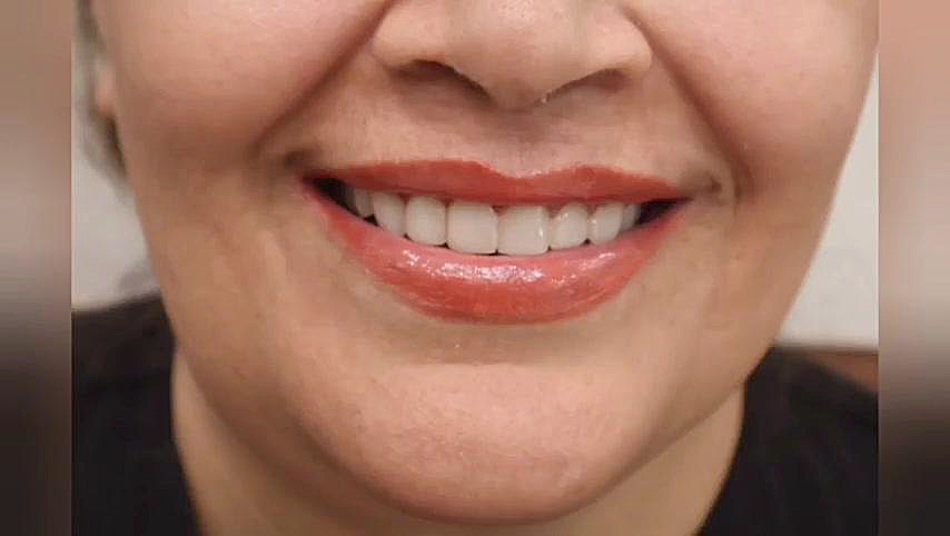 ریموت کامپوزیت های قدیمی و رفع پوسیدگی لیفت لثه فک بالا تری‌متازیدین