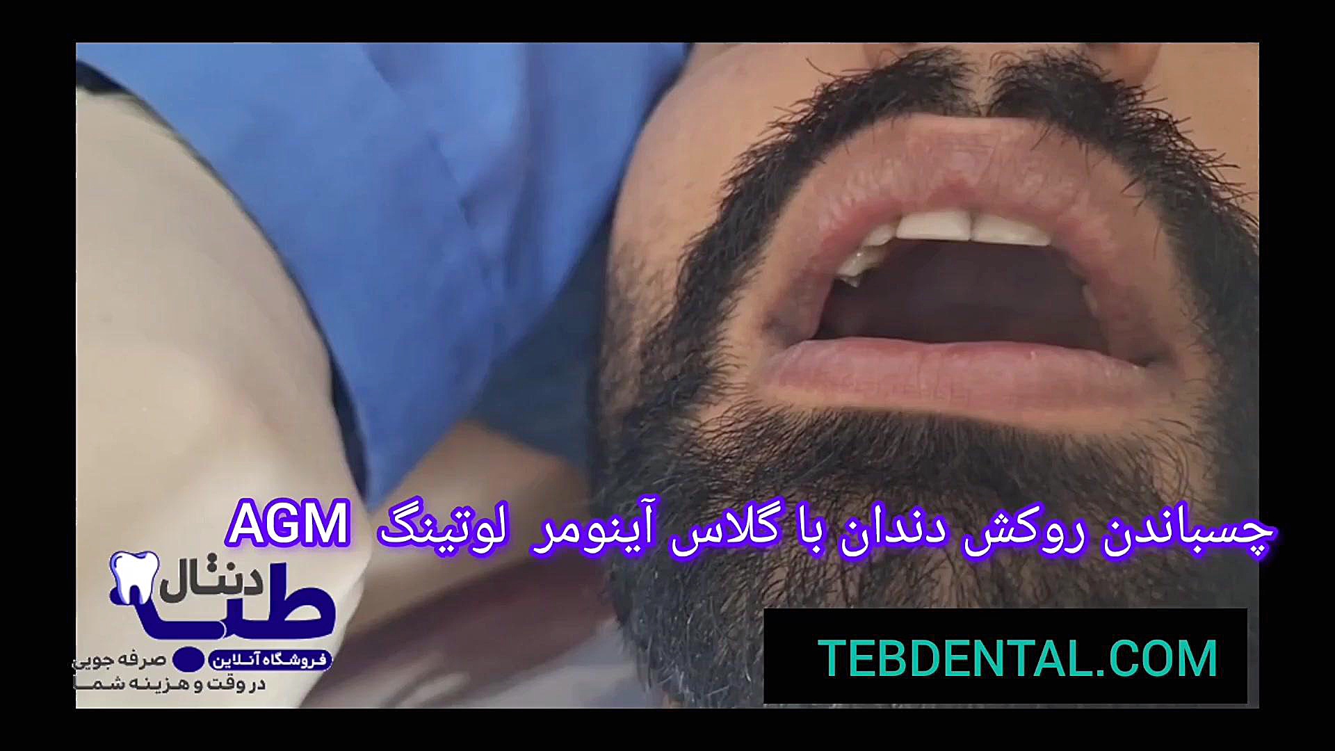 "چسباندن روکش دندان با گلاس آینومر لوتینگ AGM" اکستنشن تاج دندان