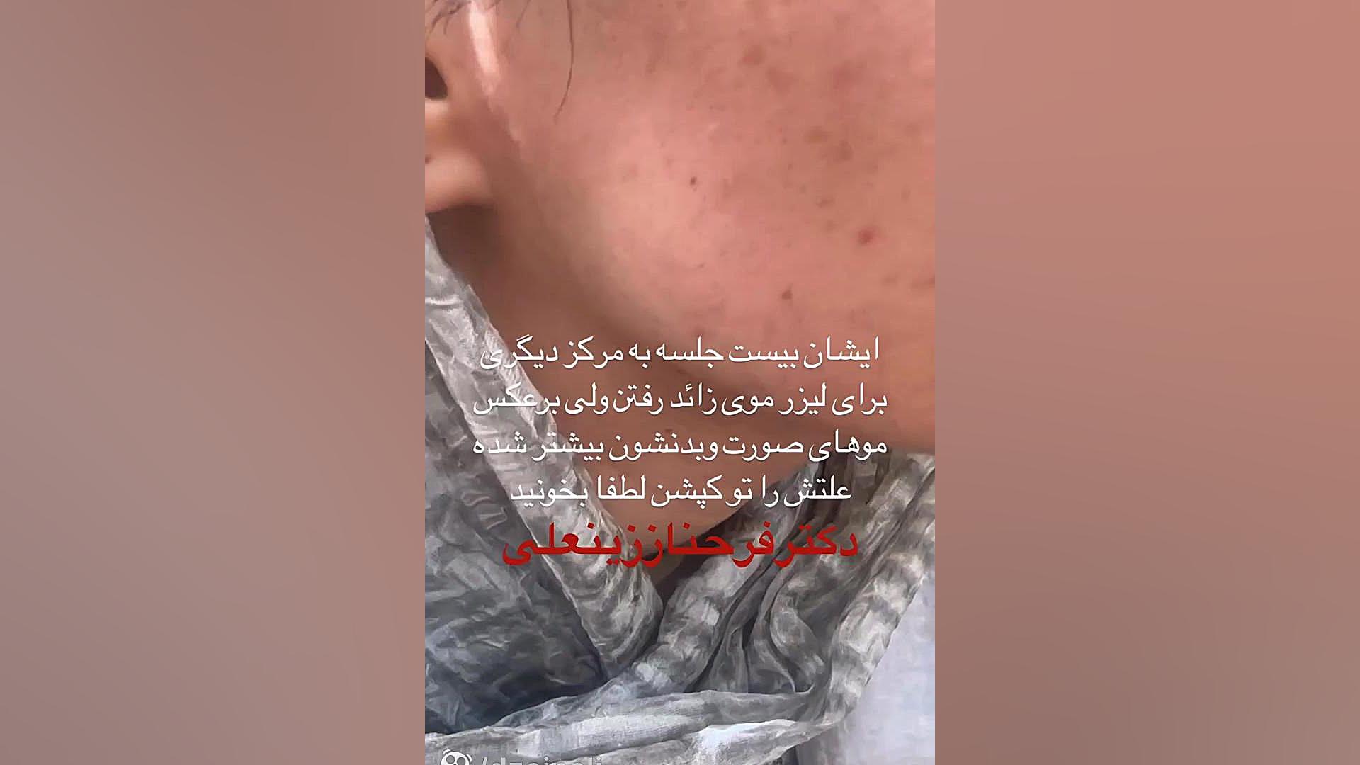 نکات مهم در مورد لیزرهای موی زاید دکتر فرحناز زینعلی - متخصص پوست، مو، زیبایی زنجان