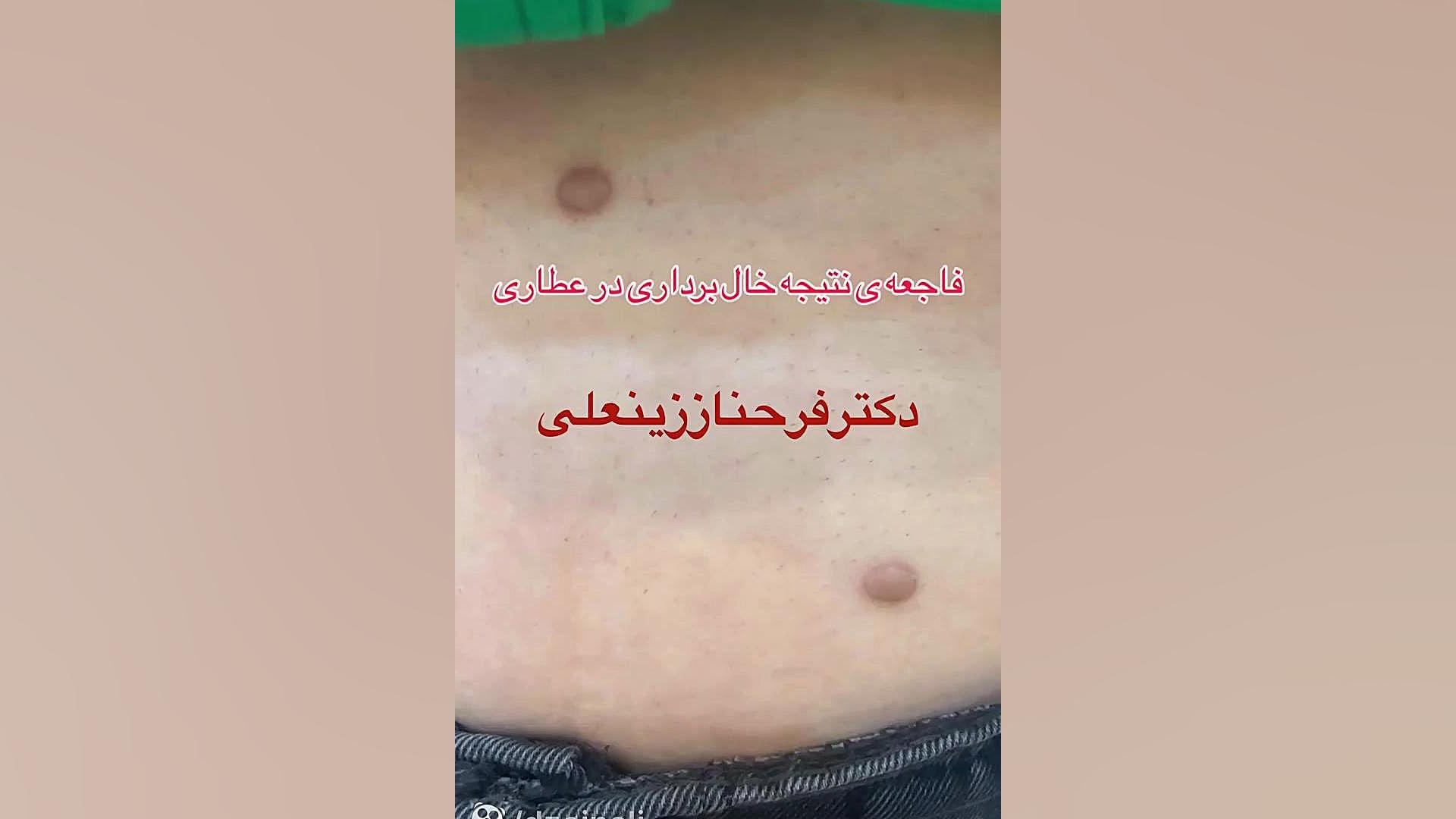 فاجعه عارضه برداشتن خال در عطاری دکتر فرحناز زینعلی - متخصص پوست، مو، زیبایی زنجان
