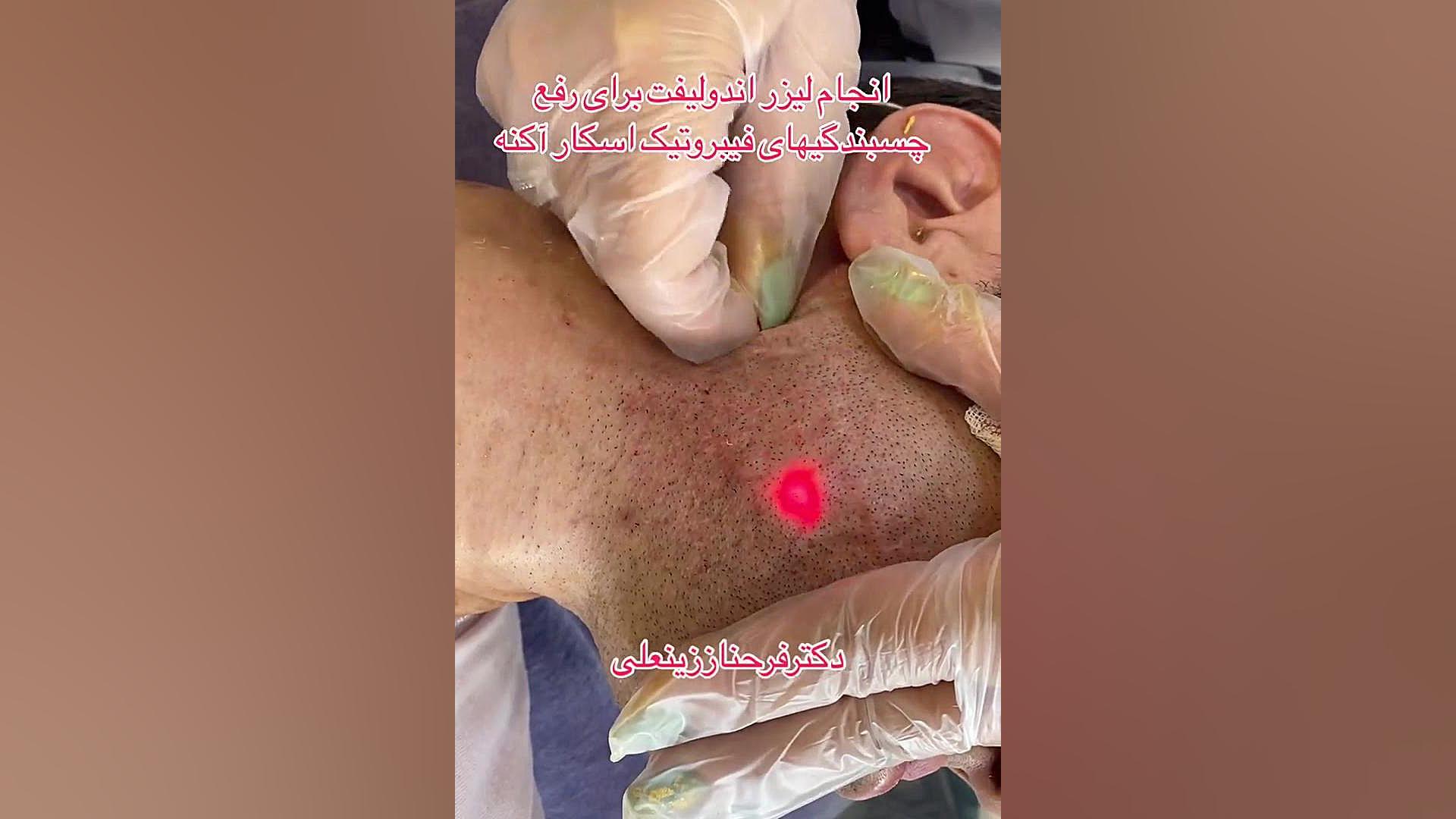 انجام لیزر اندولیفت برای رفع دائمی چسبندگی اسکار آکنه دکتر فرحناز زینعلی - متخصص پوست، مو، زیبایی زنجان