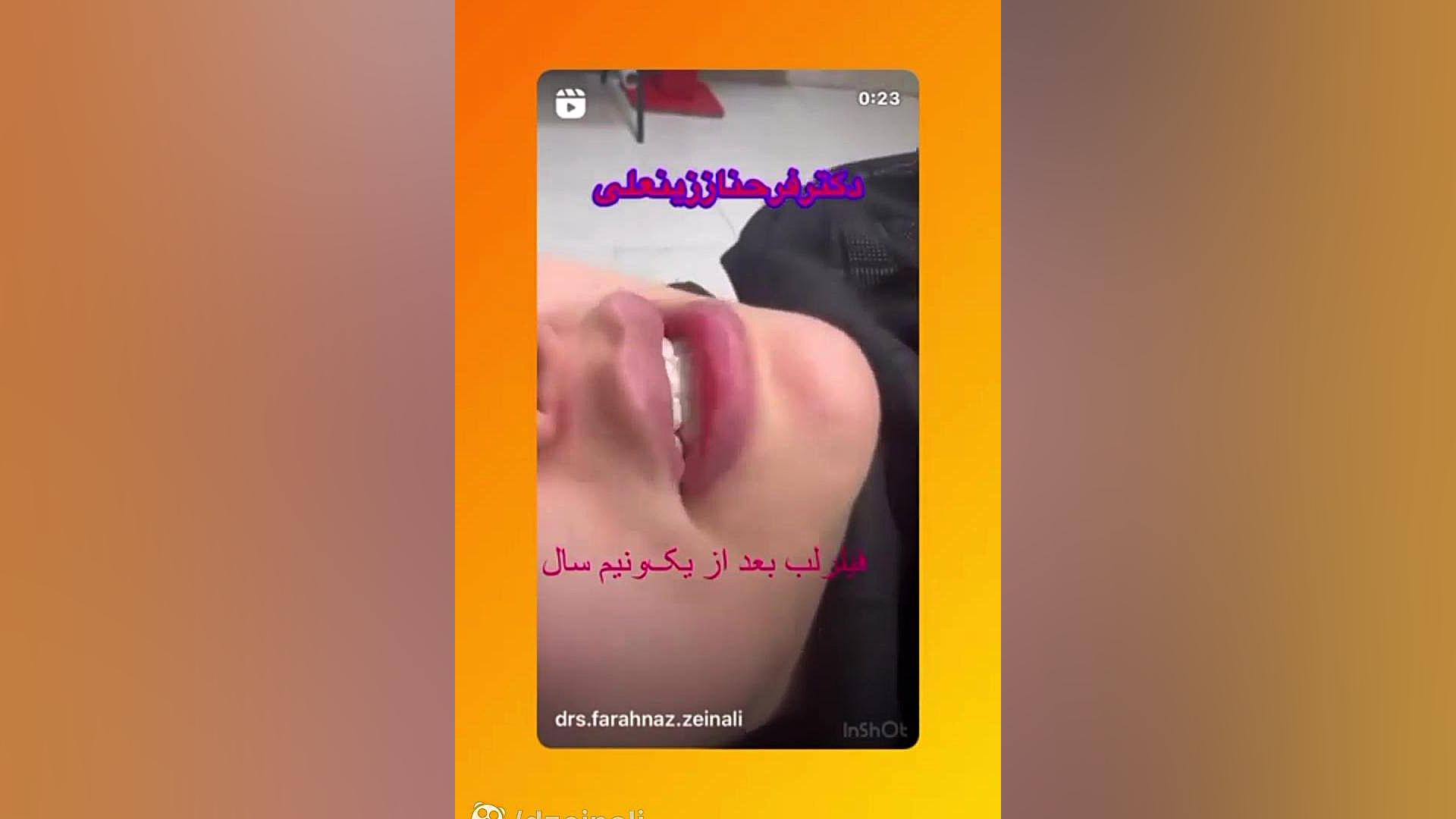 چند نمونه از فیلر لب دکتر فرحناز زینعلی - متخصص پوست، مو، زیبایی زنجان