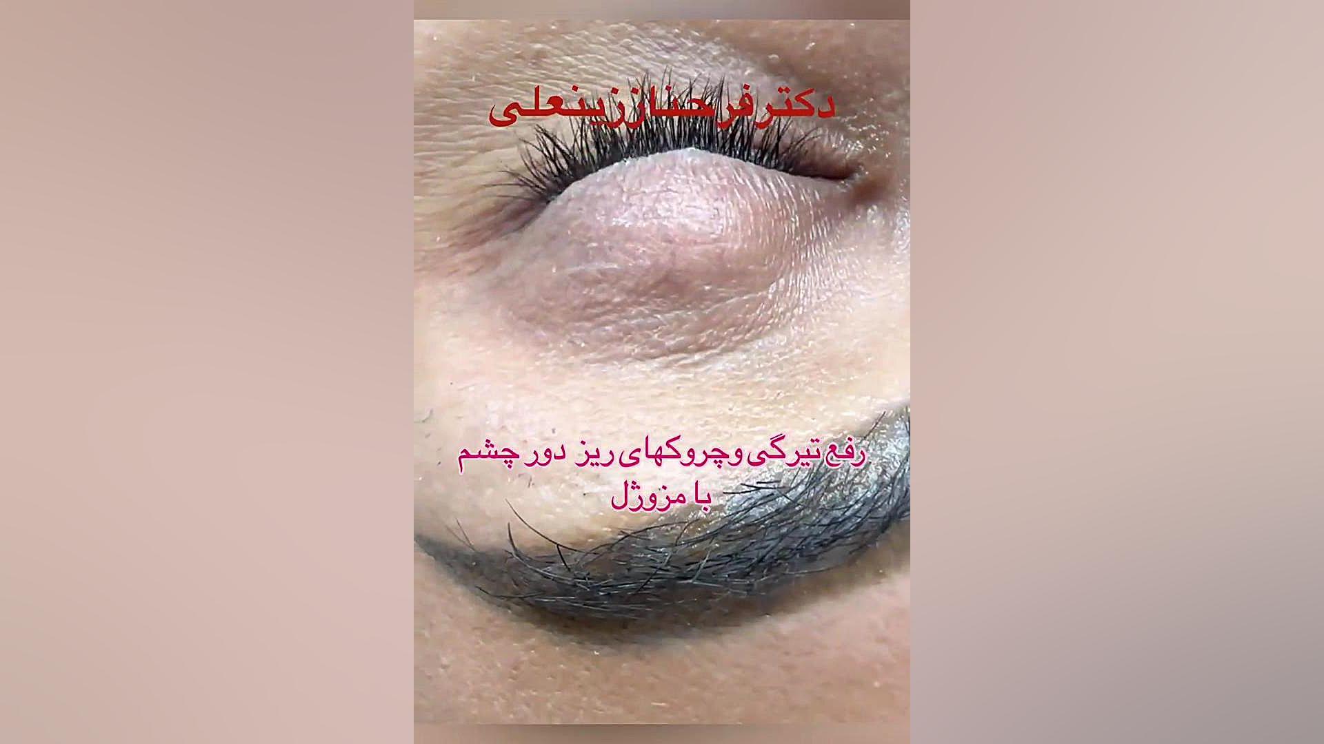 رفع تیرگی و خطوط ریز دور چشم دکتر فرحناز زینعلی - متخصص پوست، مو، زیبایی زنجان