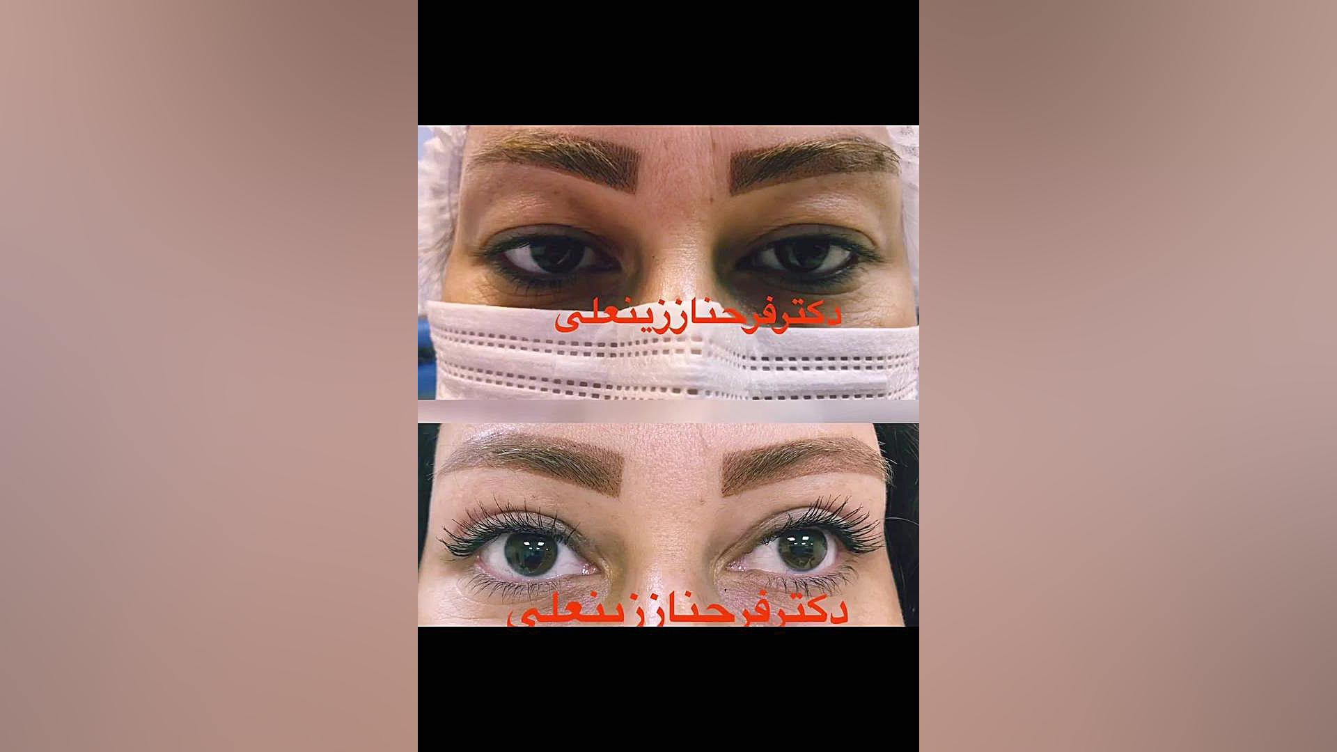 نتیجه جراحی بلفاروپلاستی پلک بالا دکتر فرحناز زینعلی - متخصص پوست، مو، زیبایی زنجان