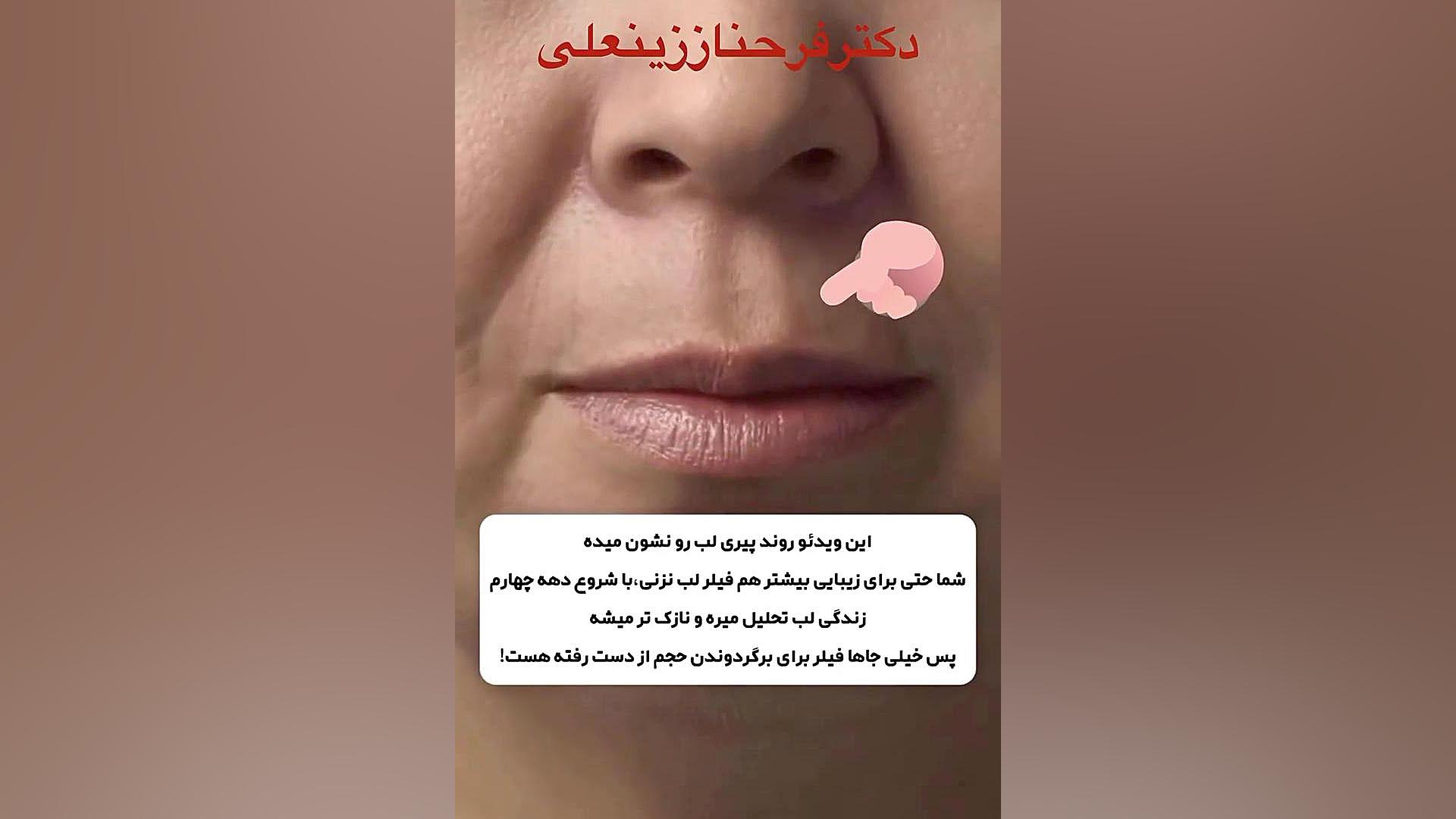 تزریق فیلر لب دکتر فرحناز زینعلی - متخصص پوست، مو، زیبایی زنجان