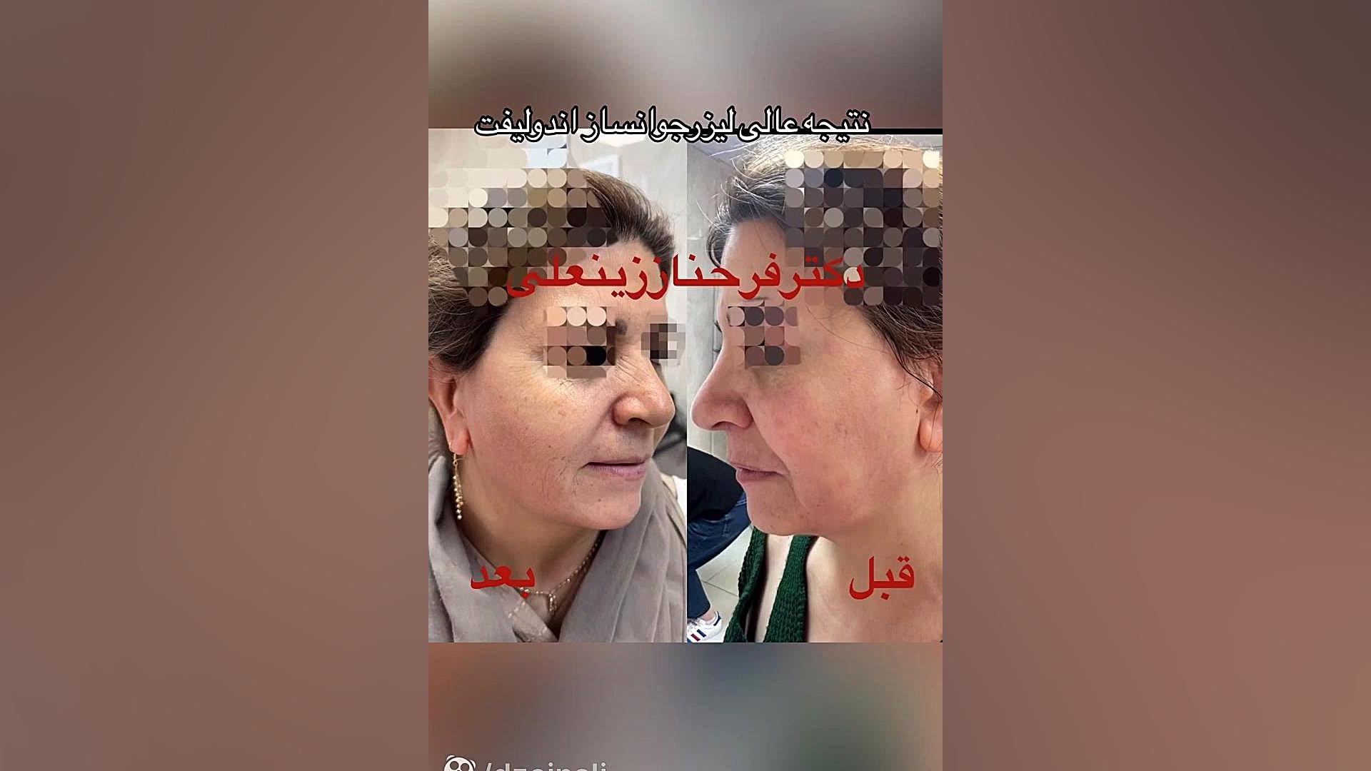 نتیجه لیزر پرقدرت اندولیفت قویترین لیزر جوانساز و لیفت کننده دکتر فرحناز زینعلی - متخصص پوست، مو، زیبایی زنجان