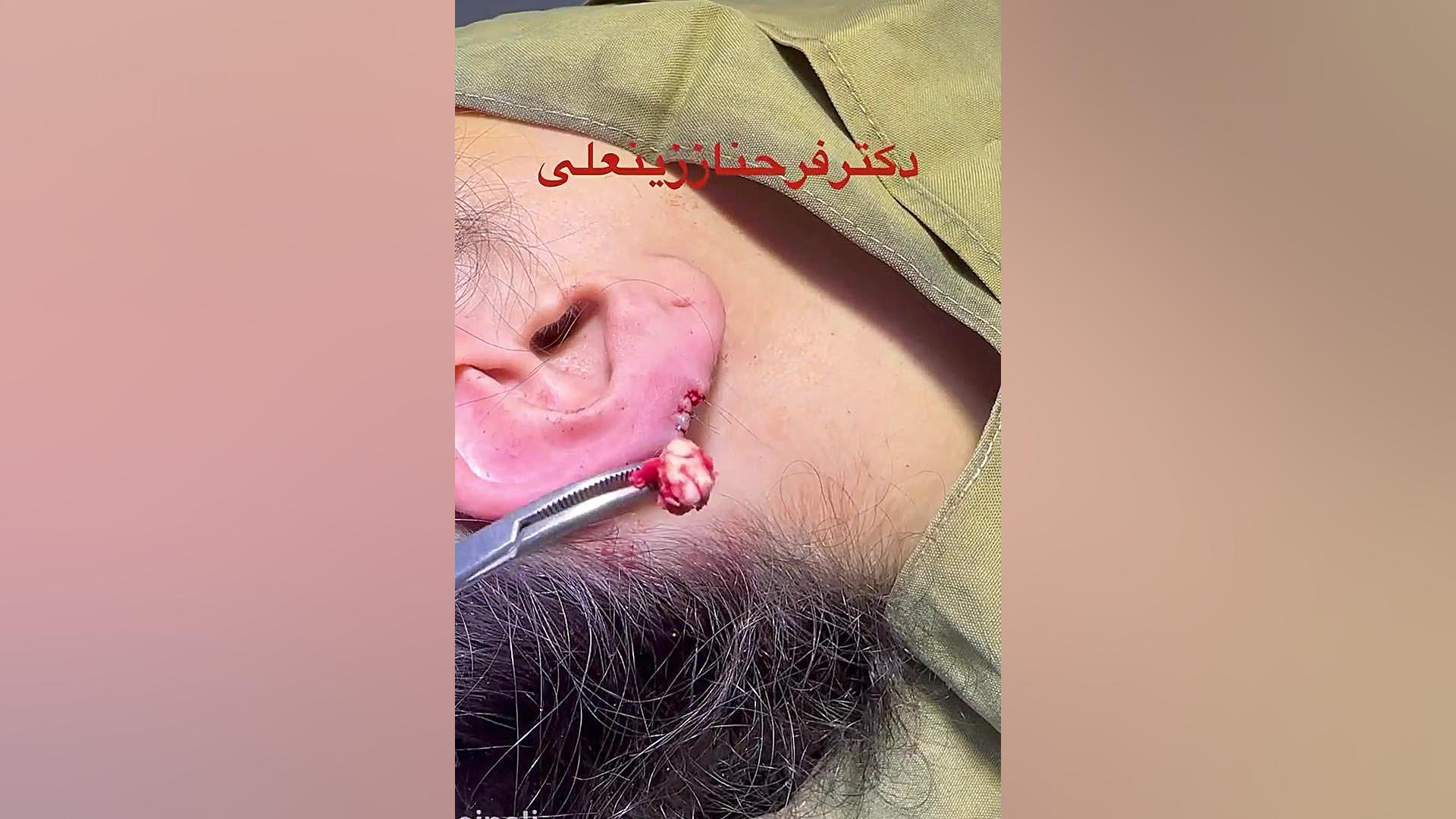 جراحی کیست کلسیفیه ناحیه گوش دکتر فرحناز زینعلی - متخصص پوست، مو، زیبایی زنجان