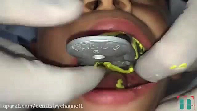 قالب گیری در ارتودنسی فک بالا رزولین