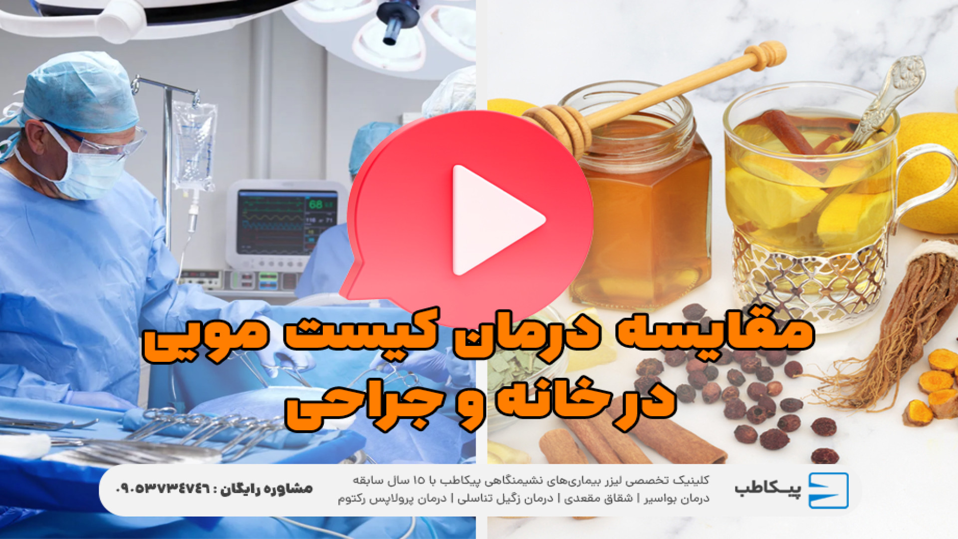 درمان خانگی کیست مویی بدون جراحی کامپوزیت ونیر