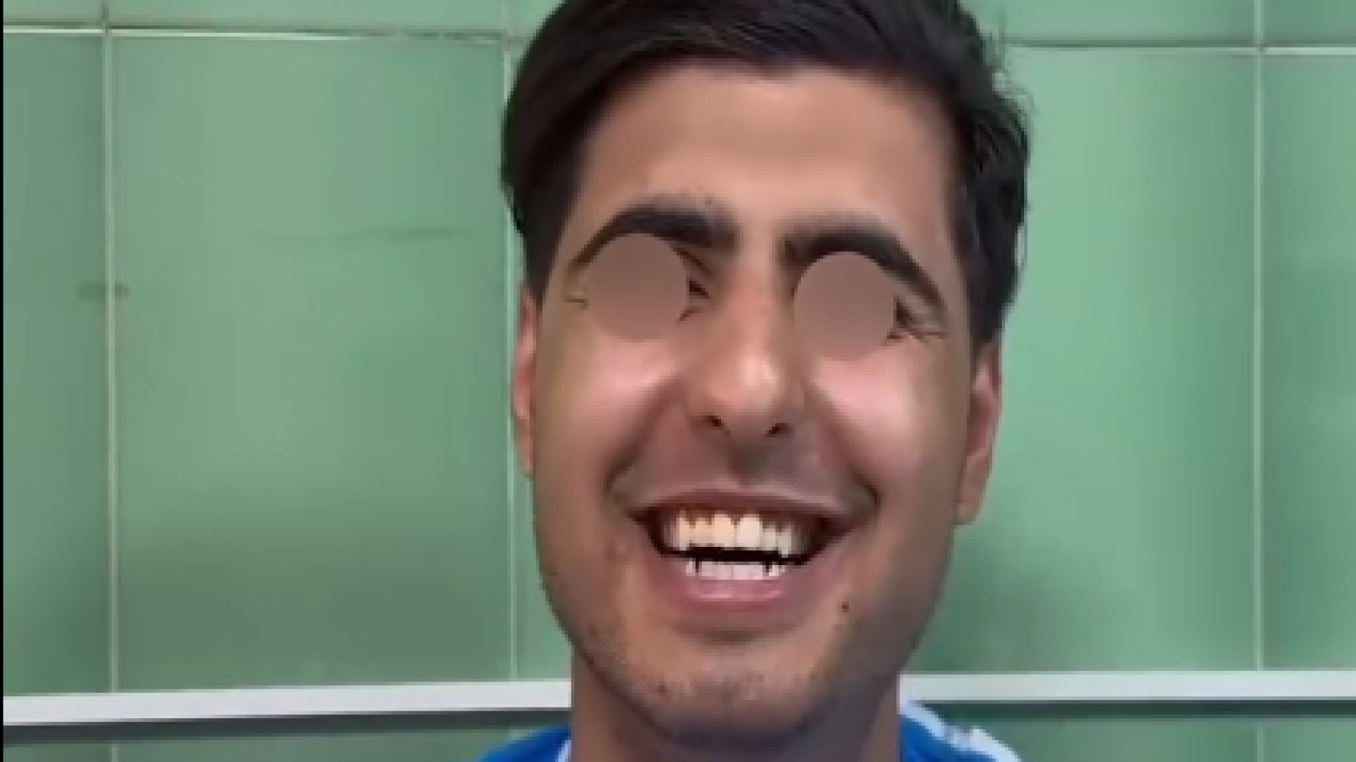 نتیجه جراحی بینی شکسته | دکتر باقری حق دکتر علی باقری حق