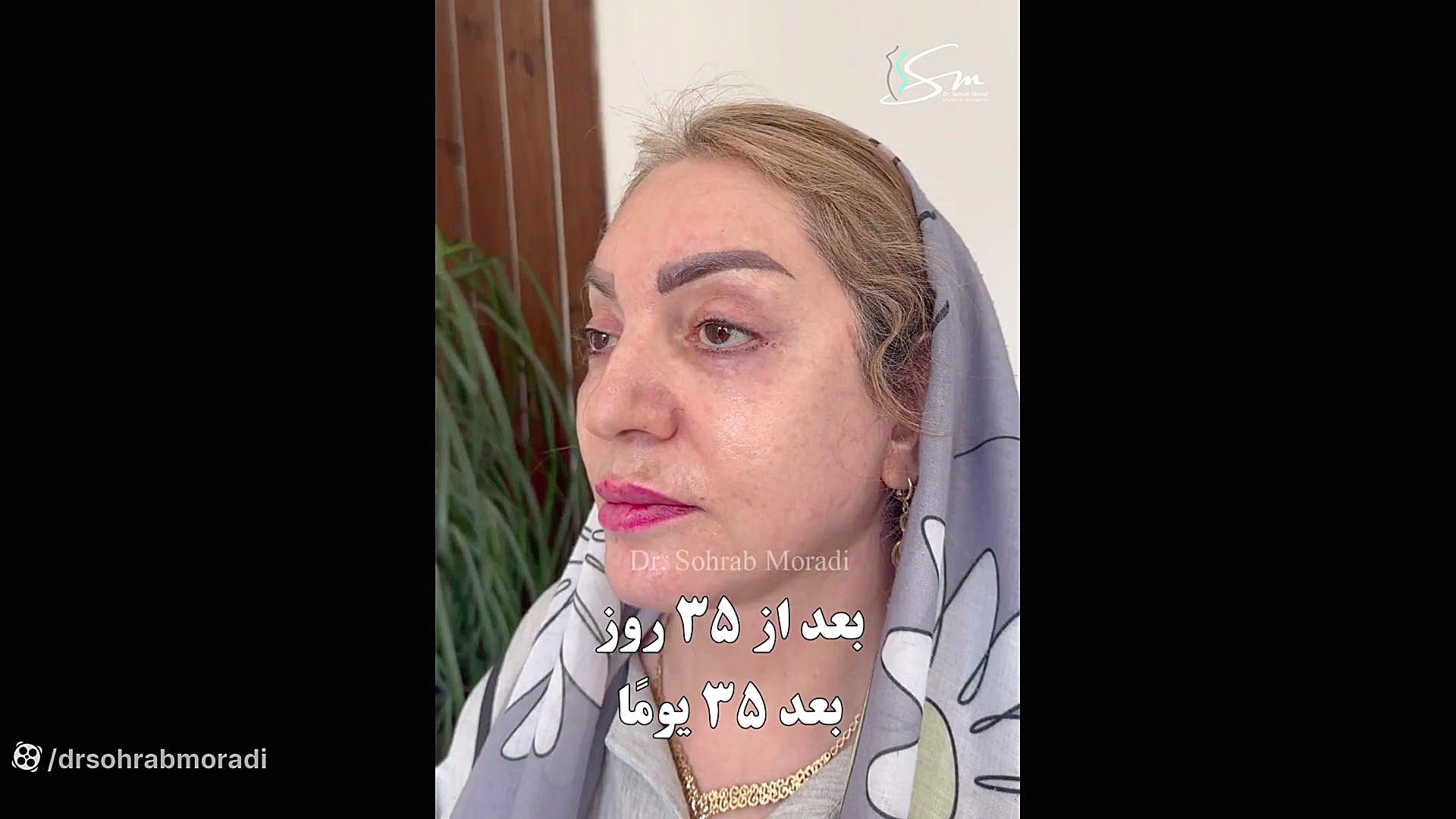 جراحی لیفت صورت و گردن توسط دکتر مرادی علامت برودزینسکی