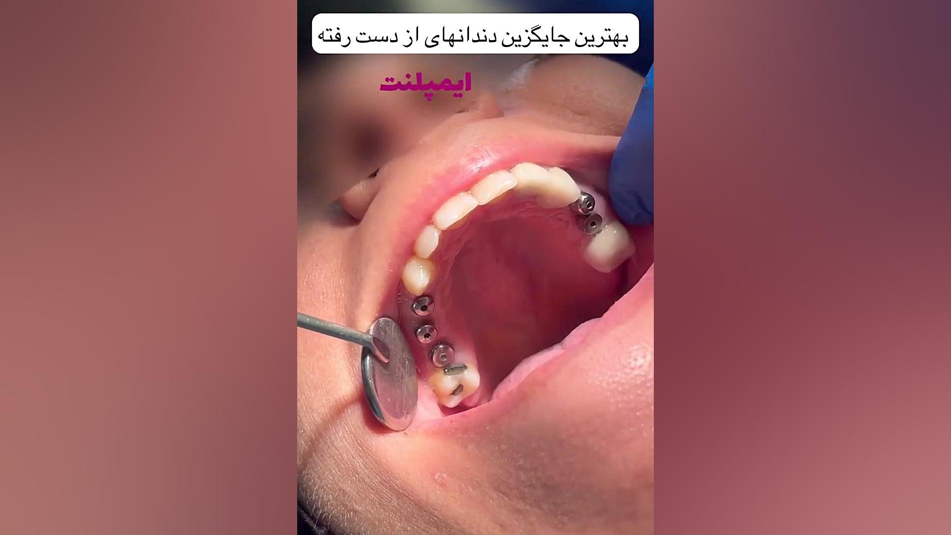 فیلم ایمپلنت تحویل روکش دندان تست کورتیزول دیورنال