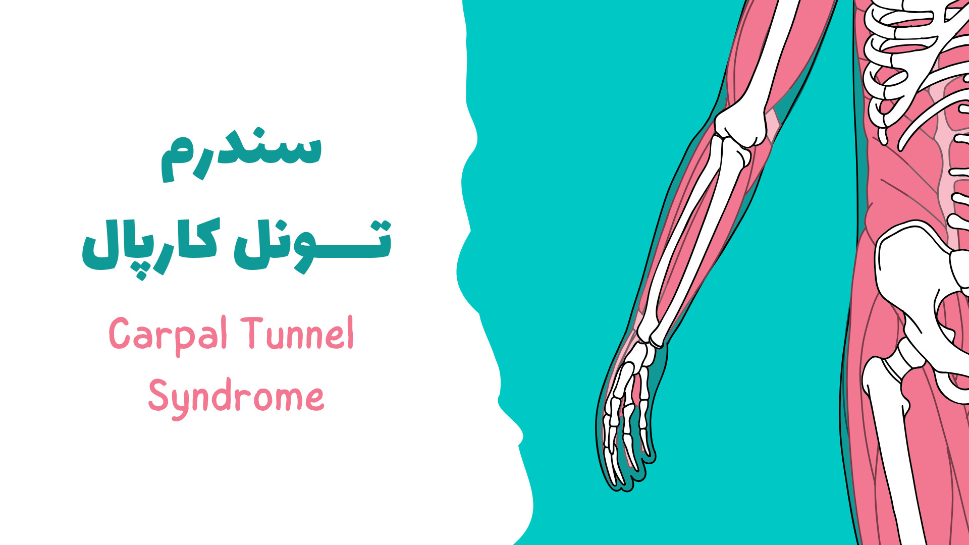 سندرم تونل کارپال (Carpal Tunnel Syndrome) سیروان خسروی