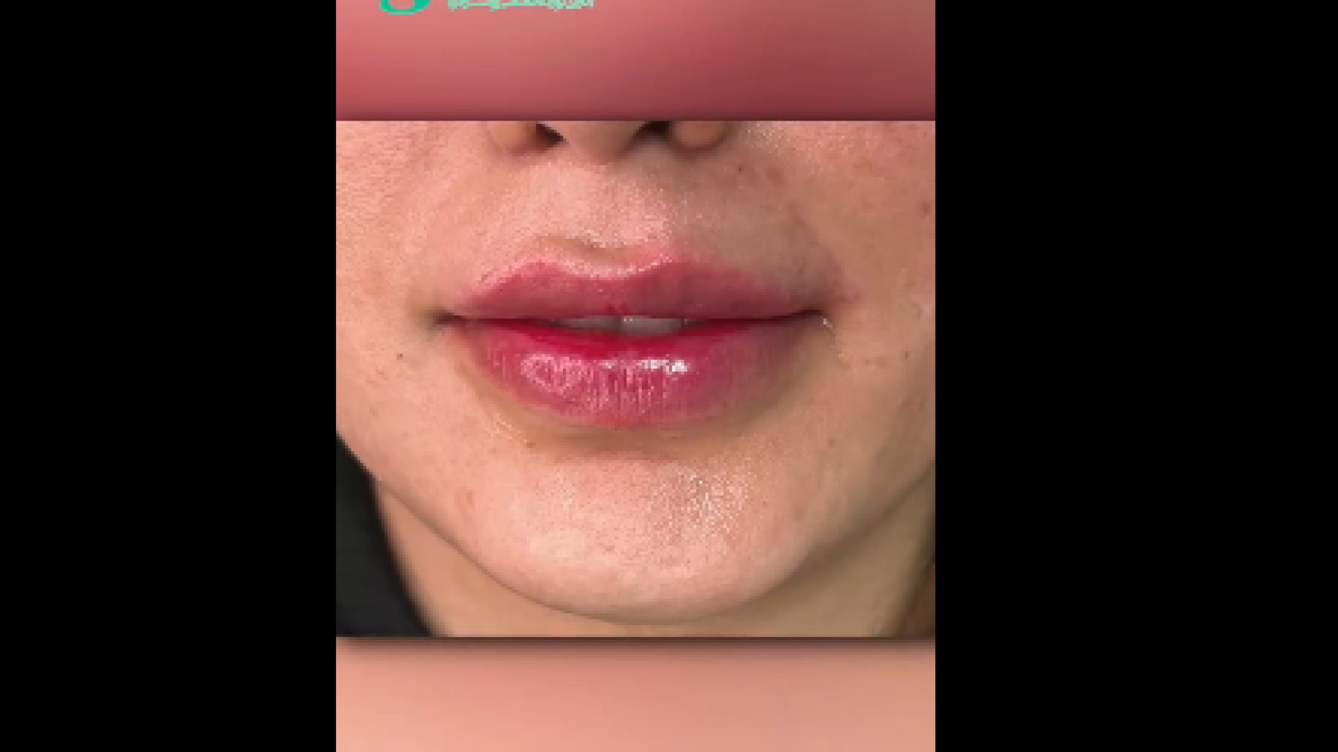 اصلاح لبخند لثه ای با تزریق فیلر لب دکتر سار ا لطفی