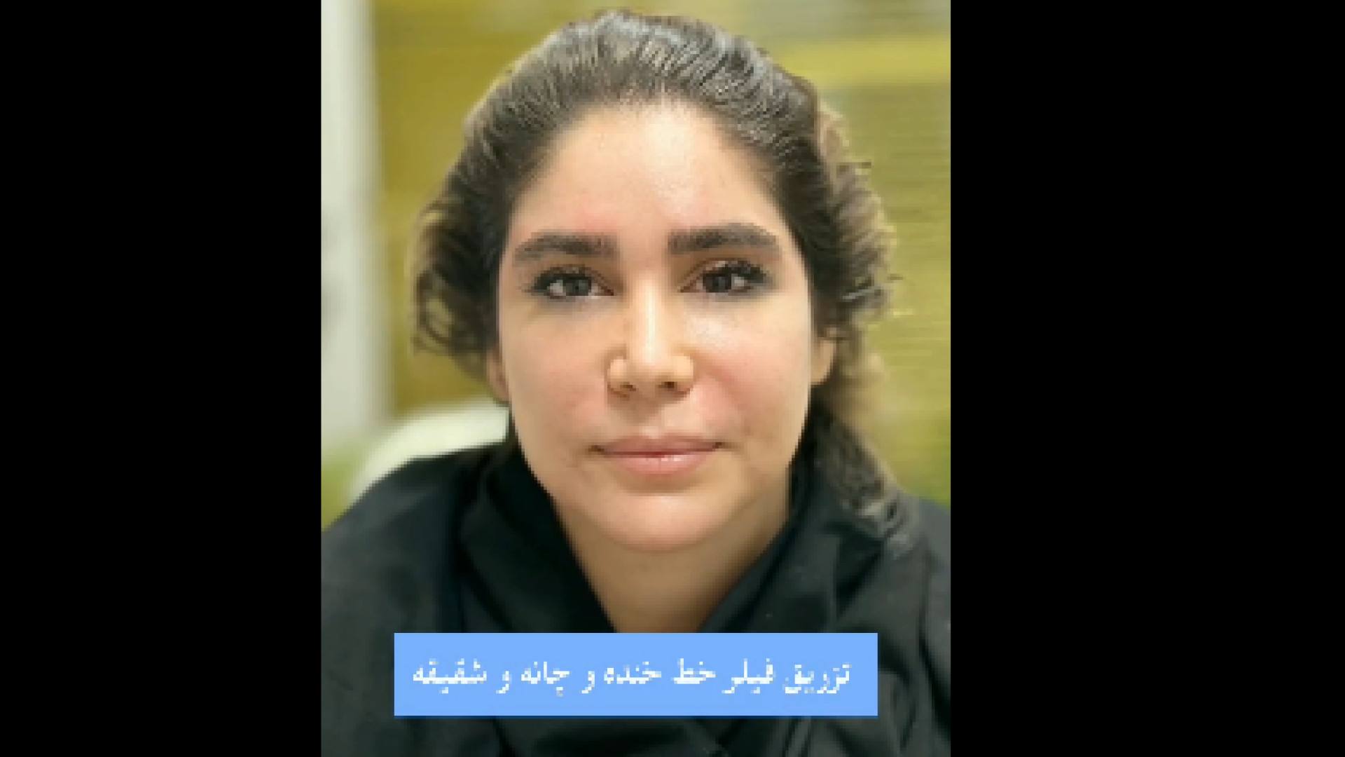 تزریق فیلر خط خنده و چانه و شقیقه دکتر سار ا لطفی