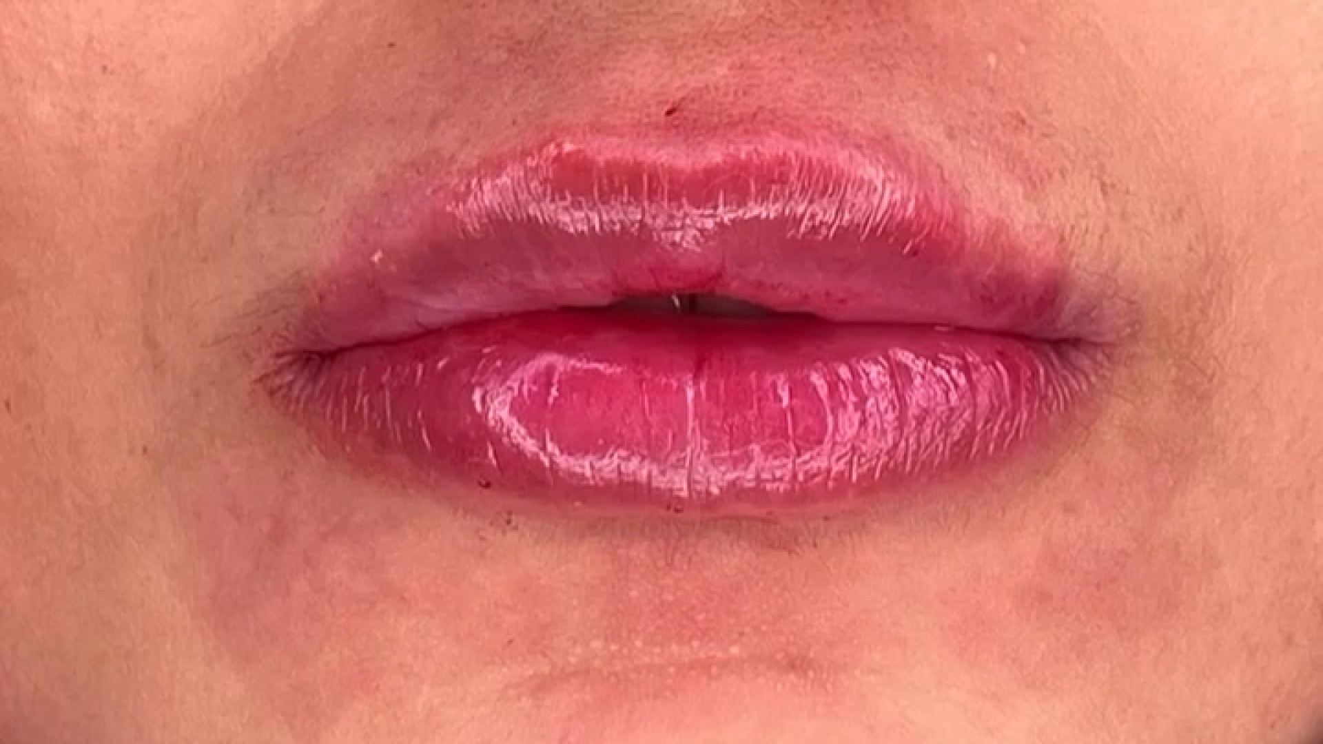 نتیجه جذاب تزریق ژل لب دکتر سار ا لطفی