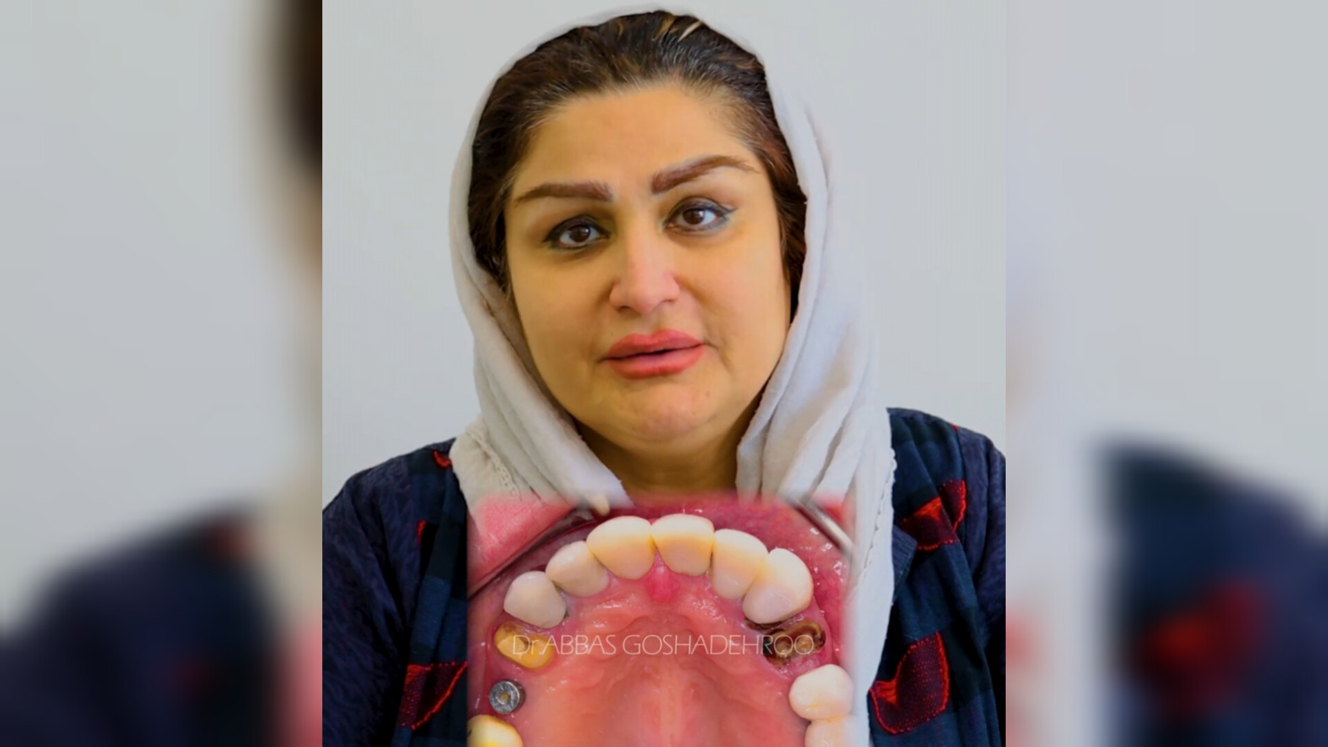 ایمپلنت واقعا معجزه میکنه؟ دکتر عباس گشاده رو، متخصص جراحی لثه و ایمپلنت